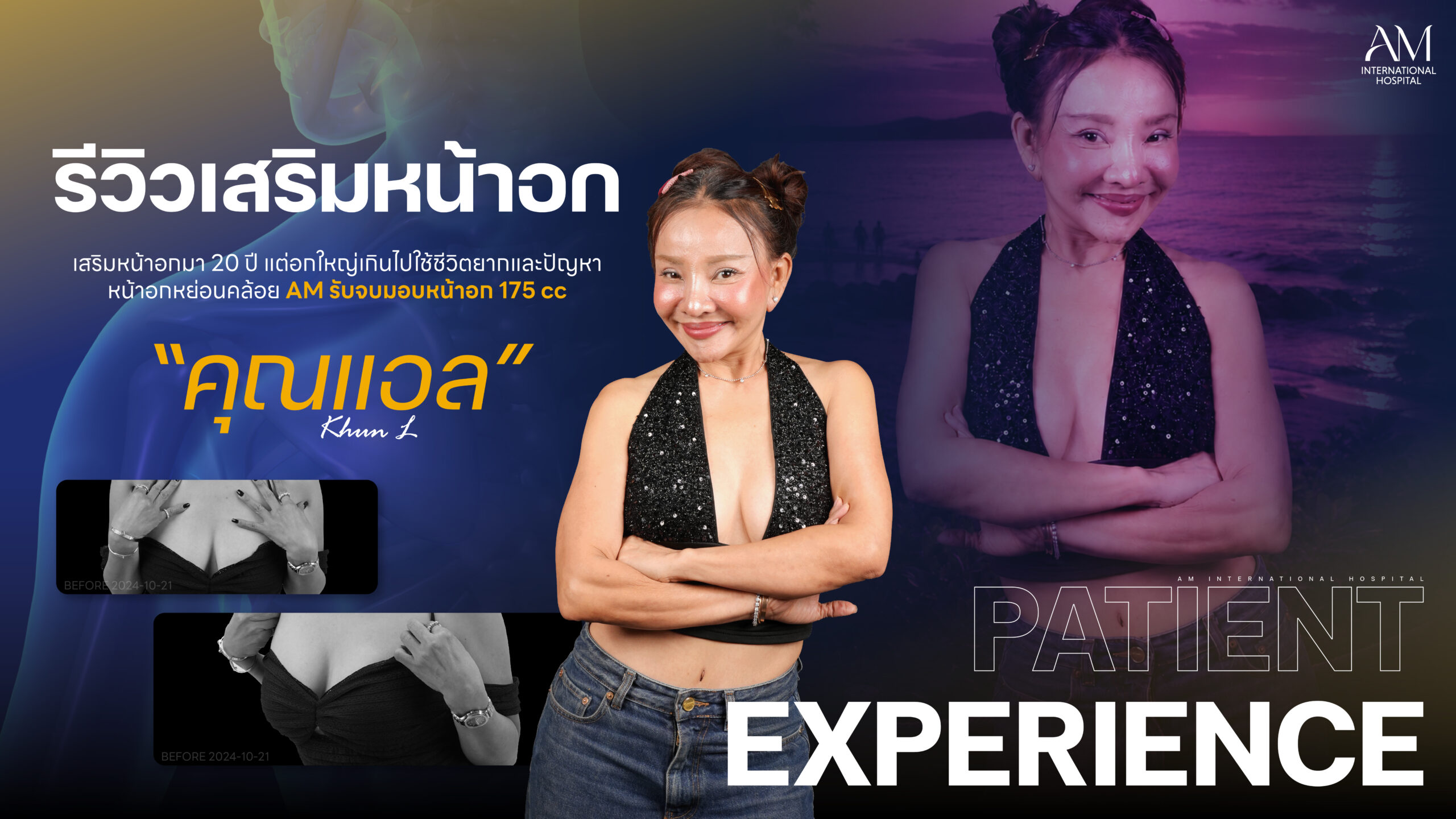รีวิวเสริมหน้าอก