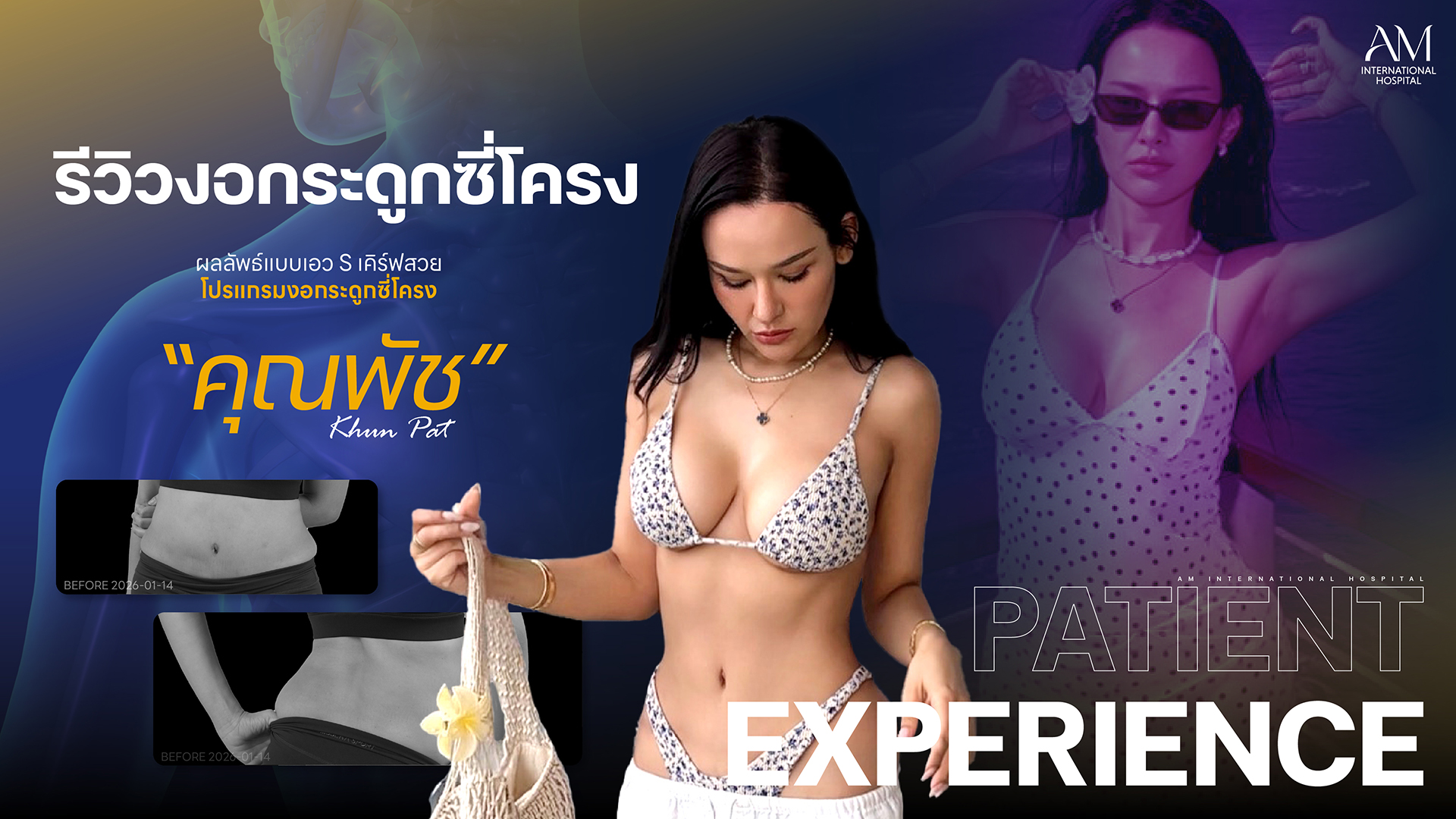 รีวิว งอกระดูกซี่โครง