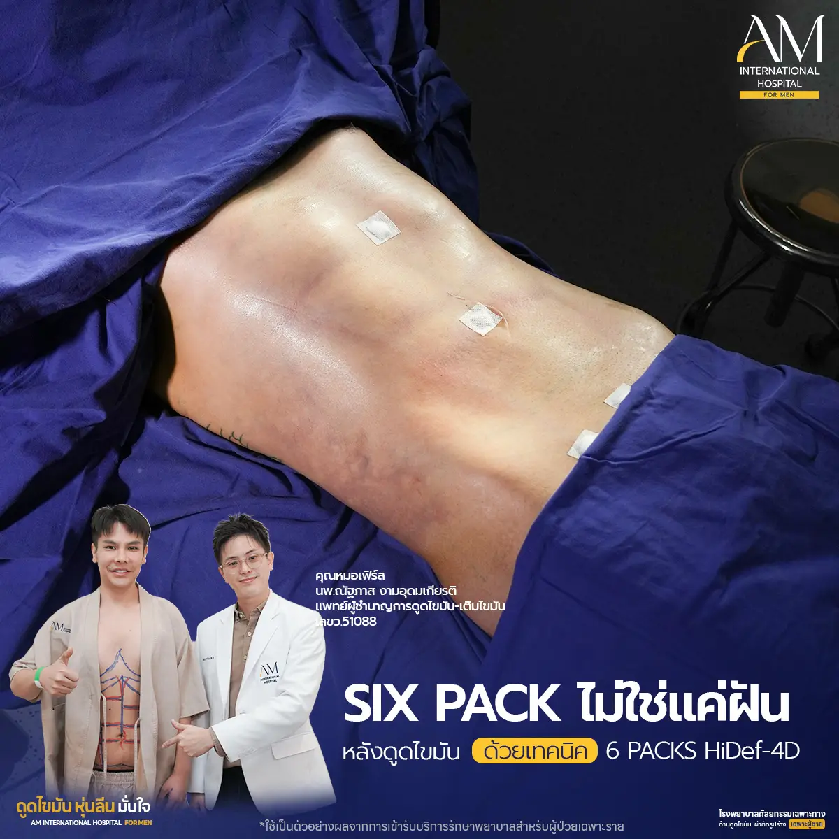 ดูดไขมันหน้าท้อง