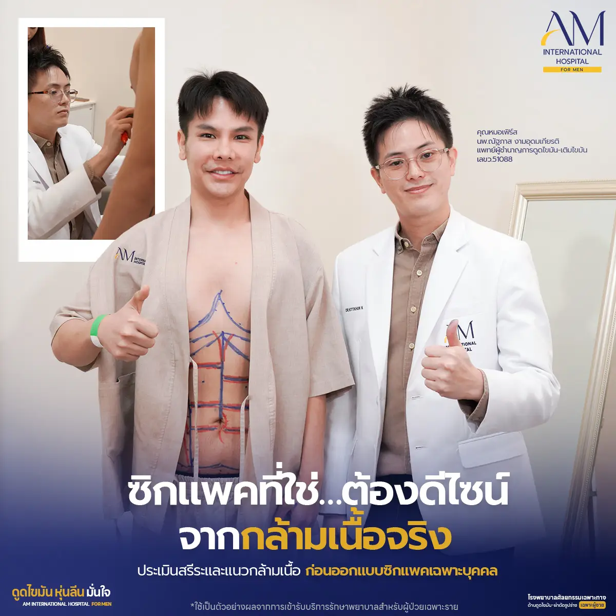 ก่อนดูดไขมัน