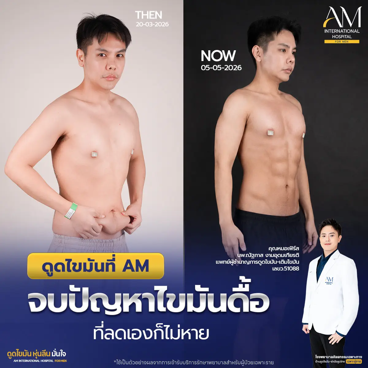 ก่อนดูดไขมัน