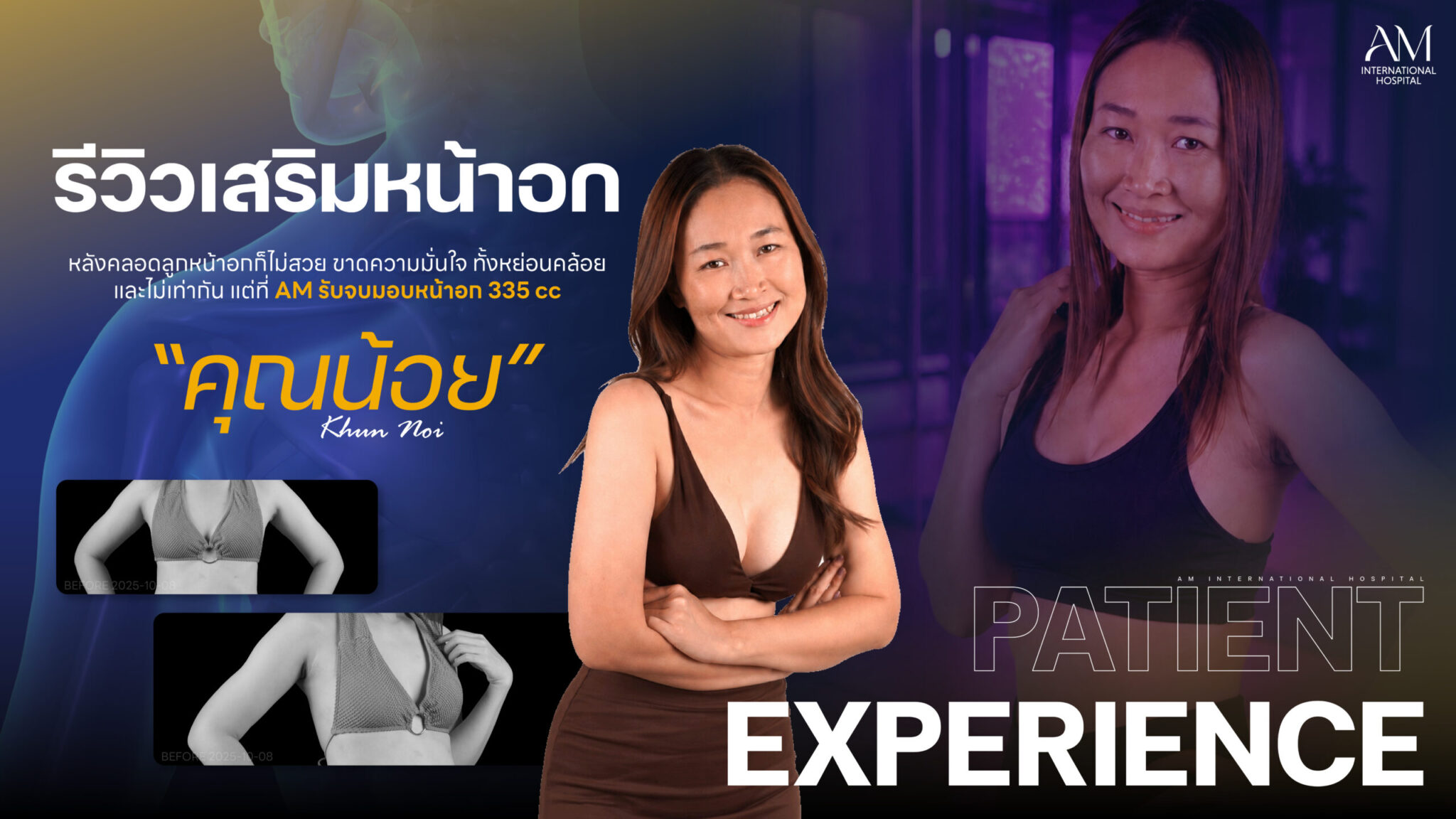 รีวิวเสริมหน้าอก