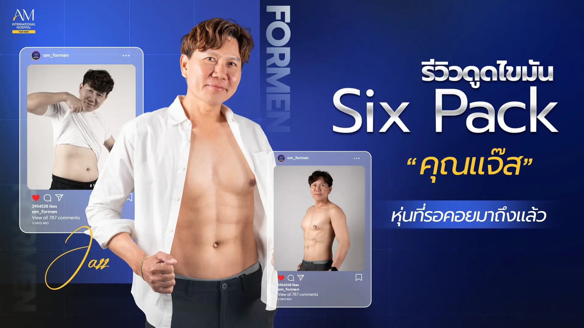รีวิวดูดไขมันซิกแพค