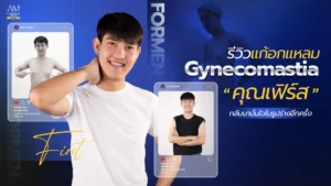 รีวิว Gynecomastia คุณเฟิร์ส
