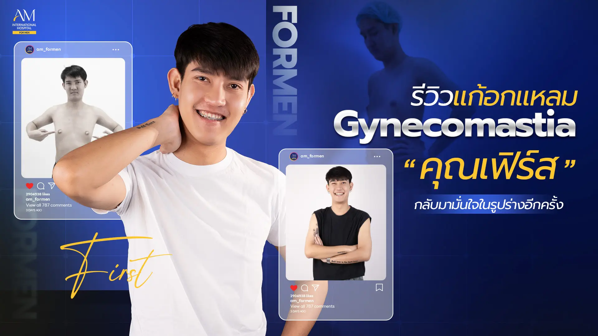 รีวิว Gynecomastia คุณเฟิร์ส