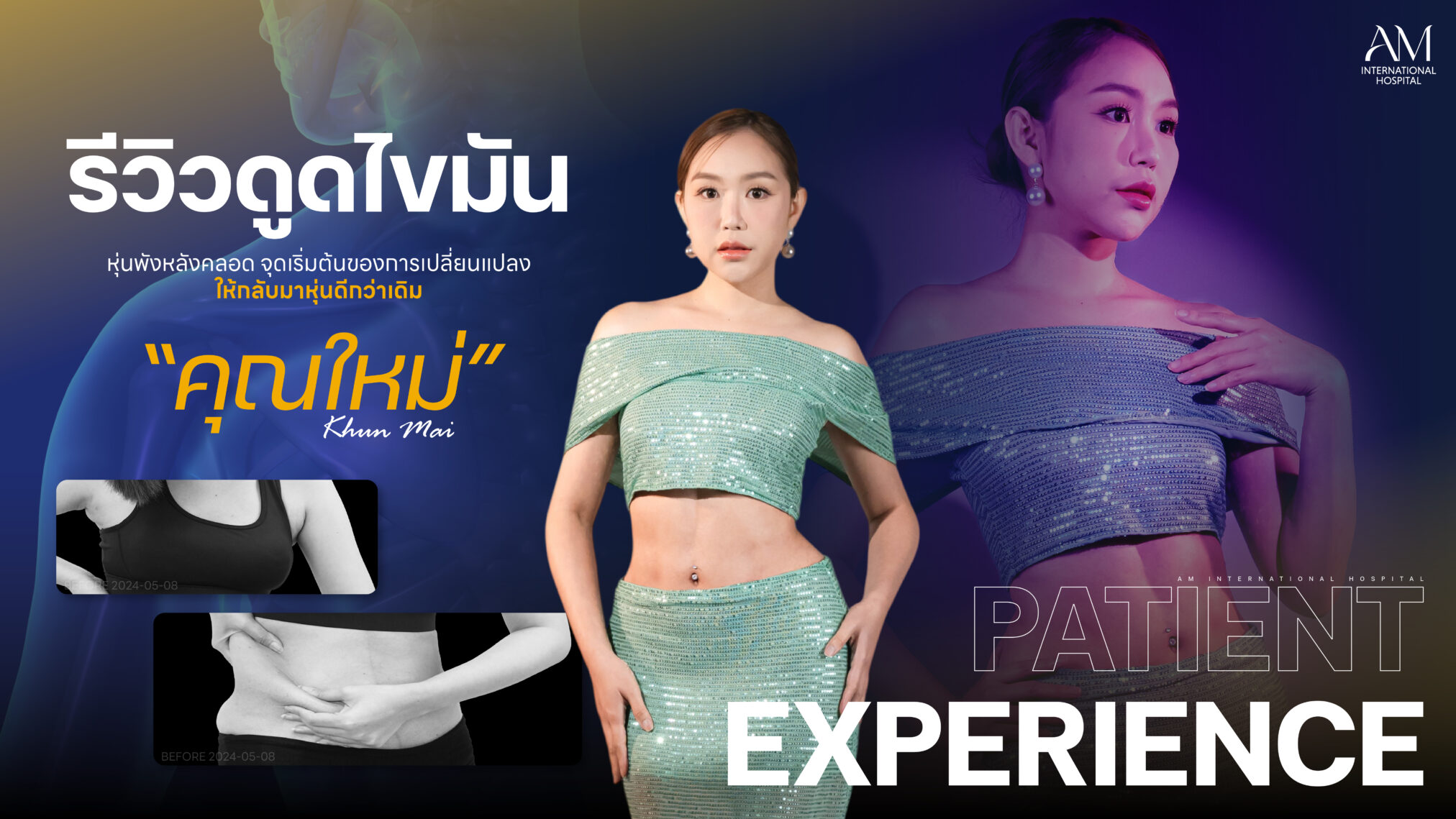 รีวิวดูดไขมัน