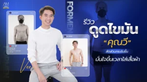 รีวิวดูดไขมันผู้ชาย