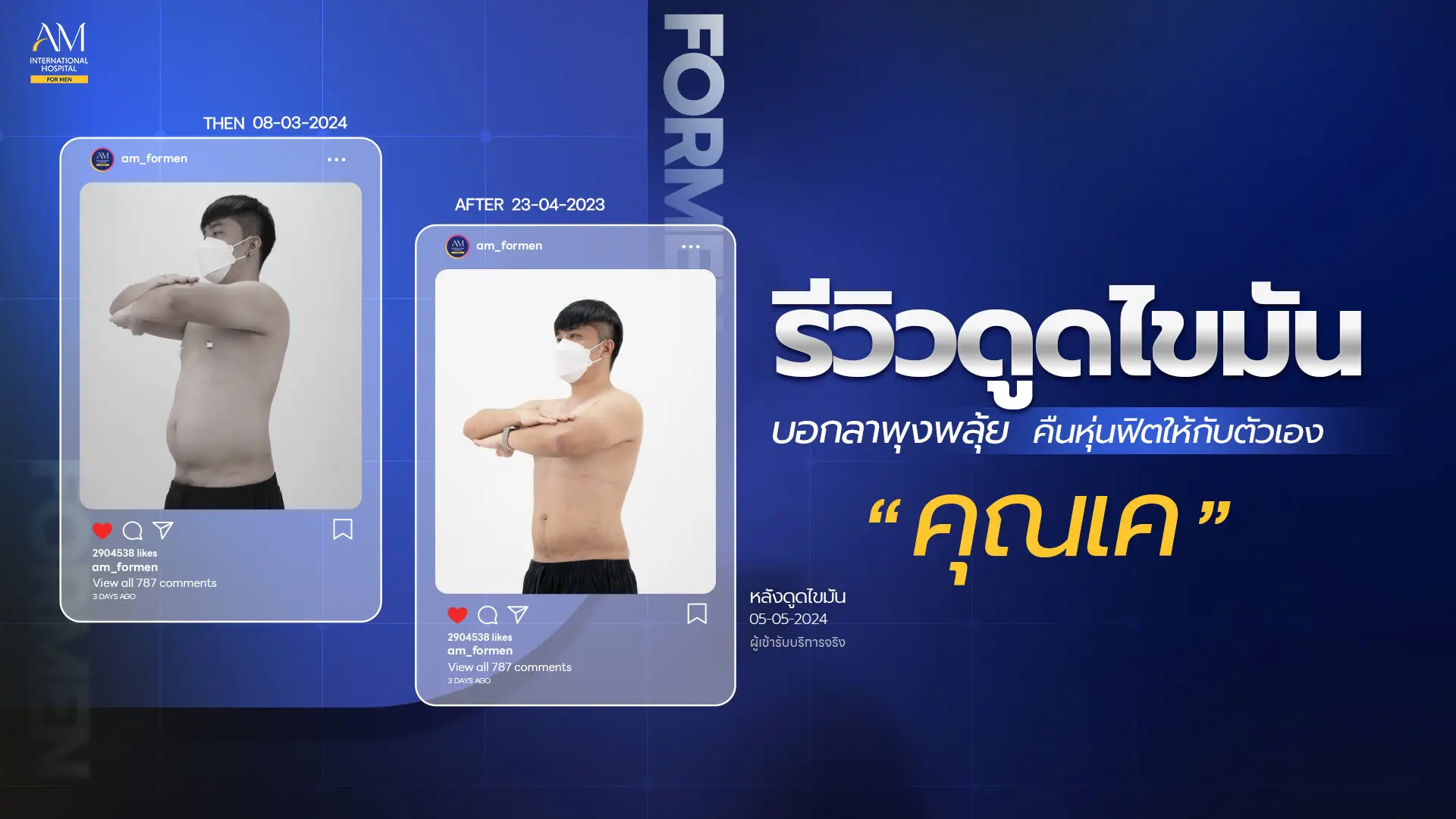 รีวิวดูดไขมัน