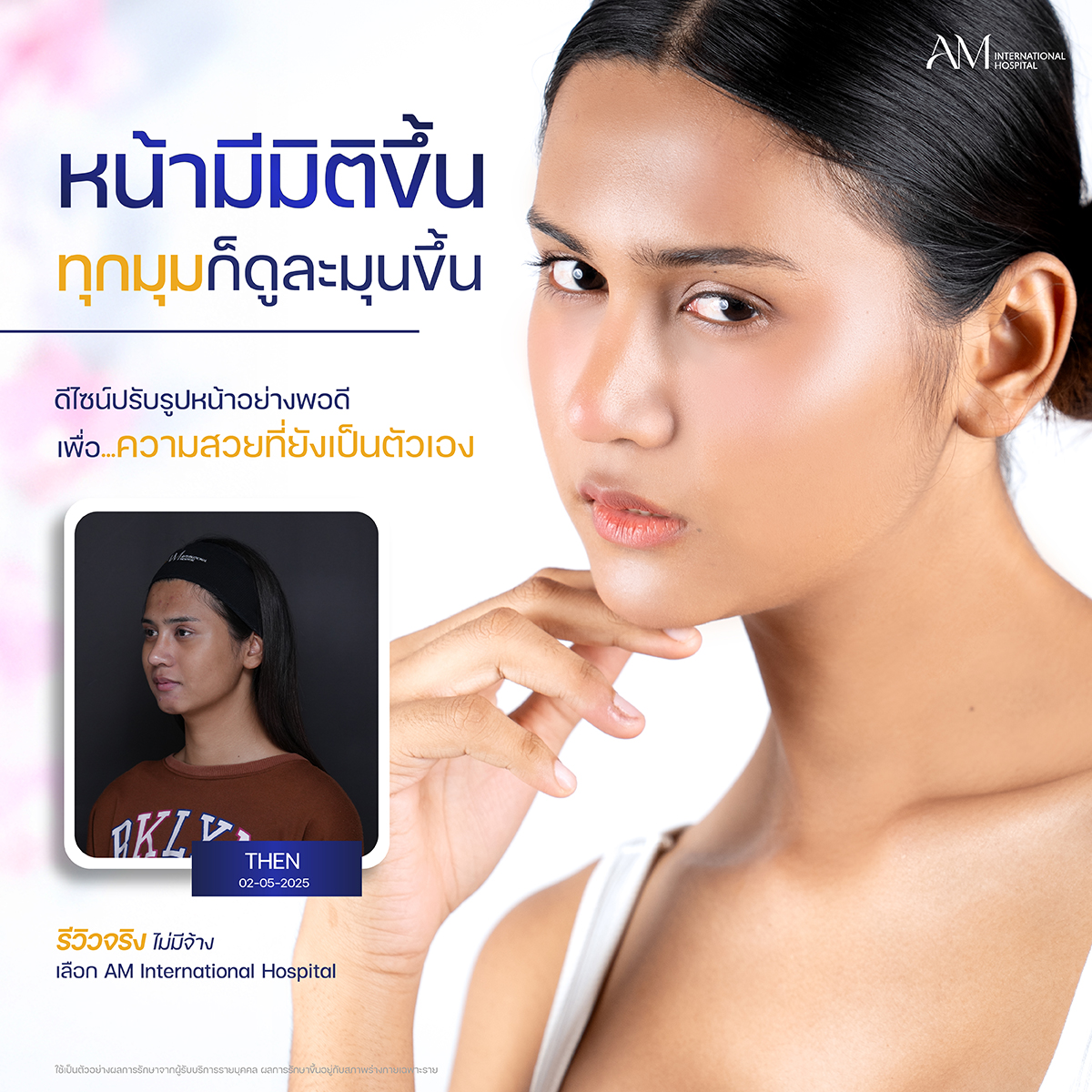 หลังฉีดโปรแกรมฟิลเลอร์