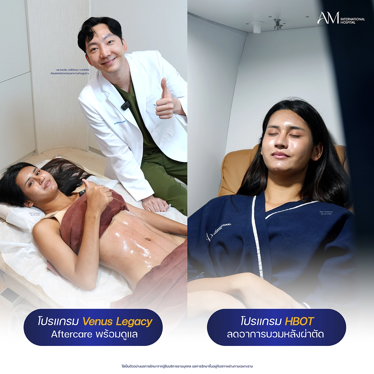 โปรแกรม Aftercare หลัง งอกระดูกซี่โครง และ เสริมหน้าอก
