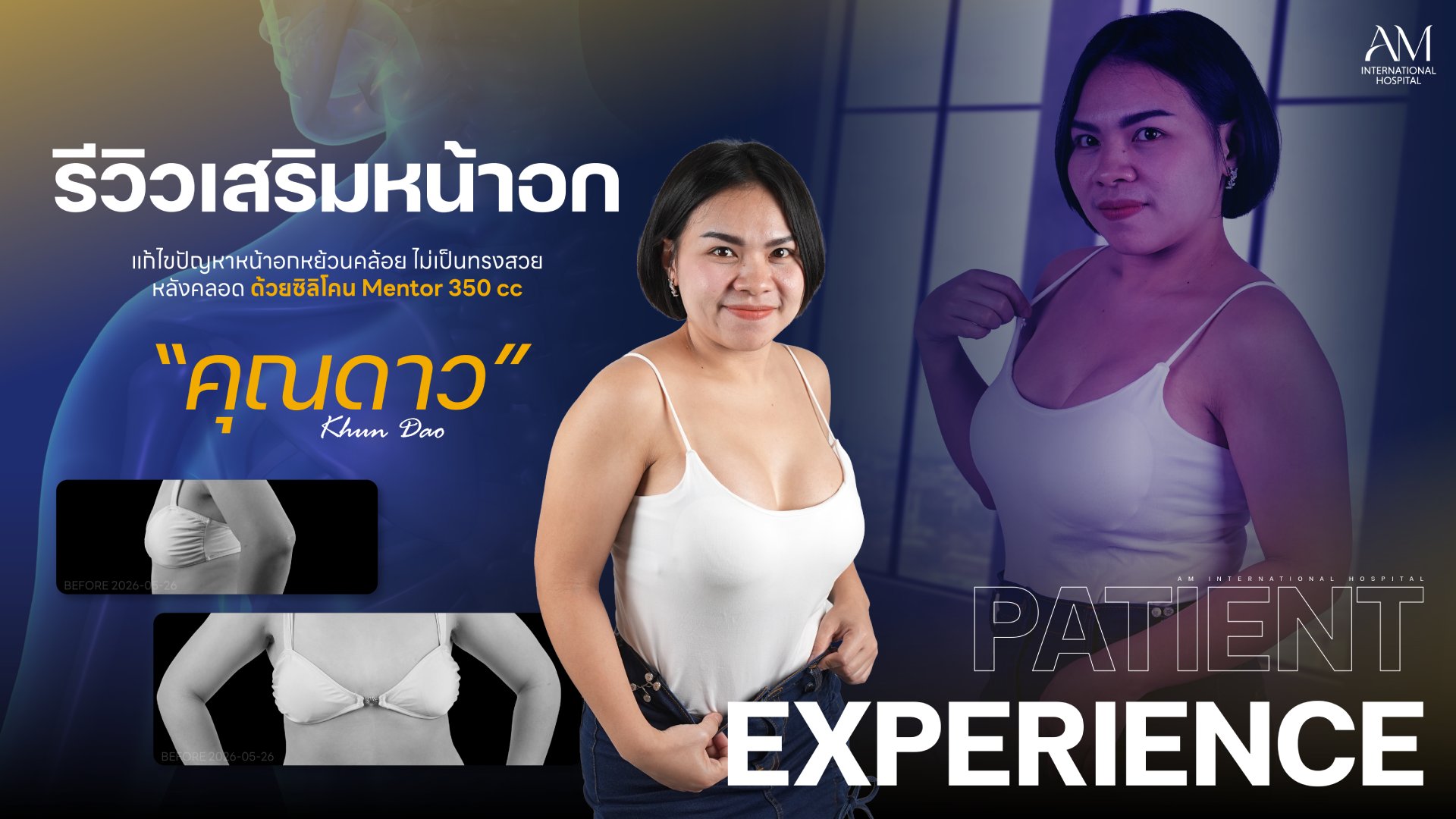 รีรีวิวเสริมหน้าอก 350 CC “คุณดาว” แก้หน้าอกคล้อย โดยหมอบาส