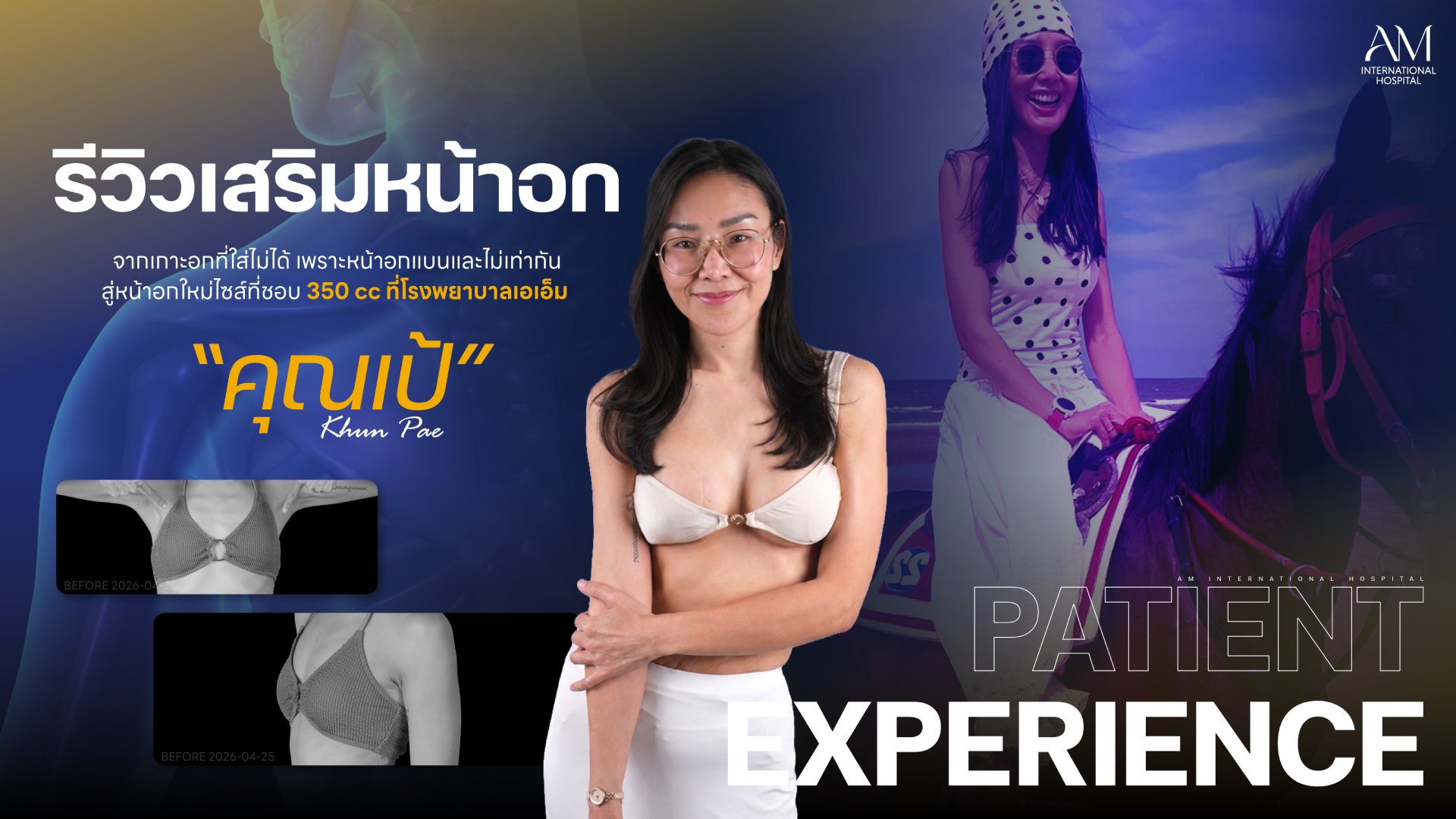 รีวิวเสริมหน้าอก