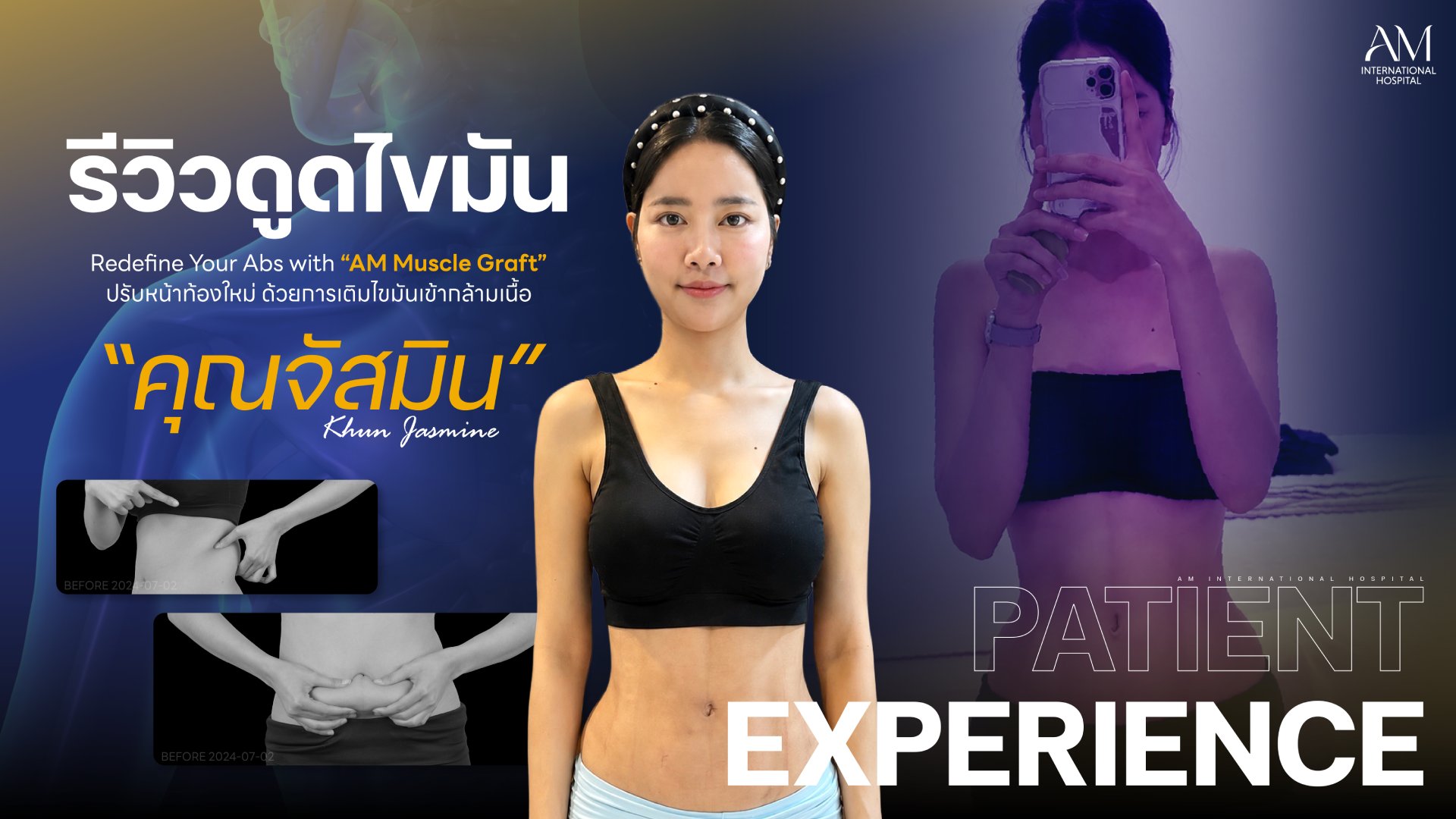 รีวิวดูดไขมัน