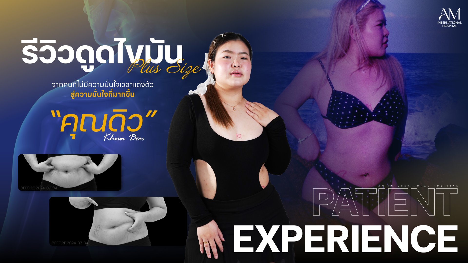รีวิวดูดไขมัน