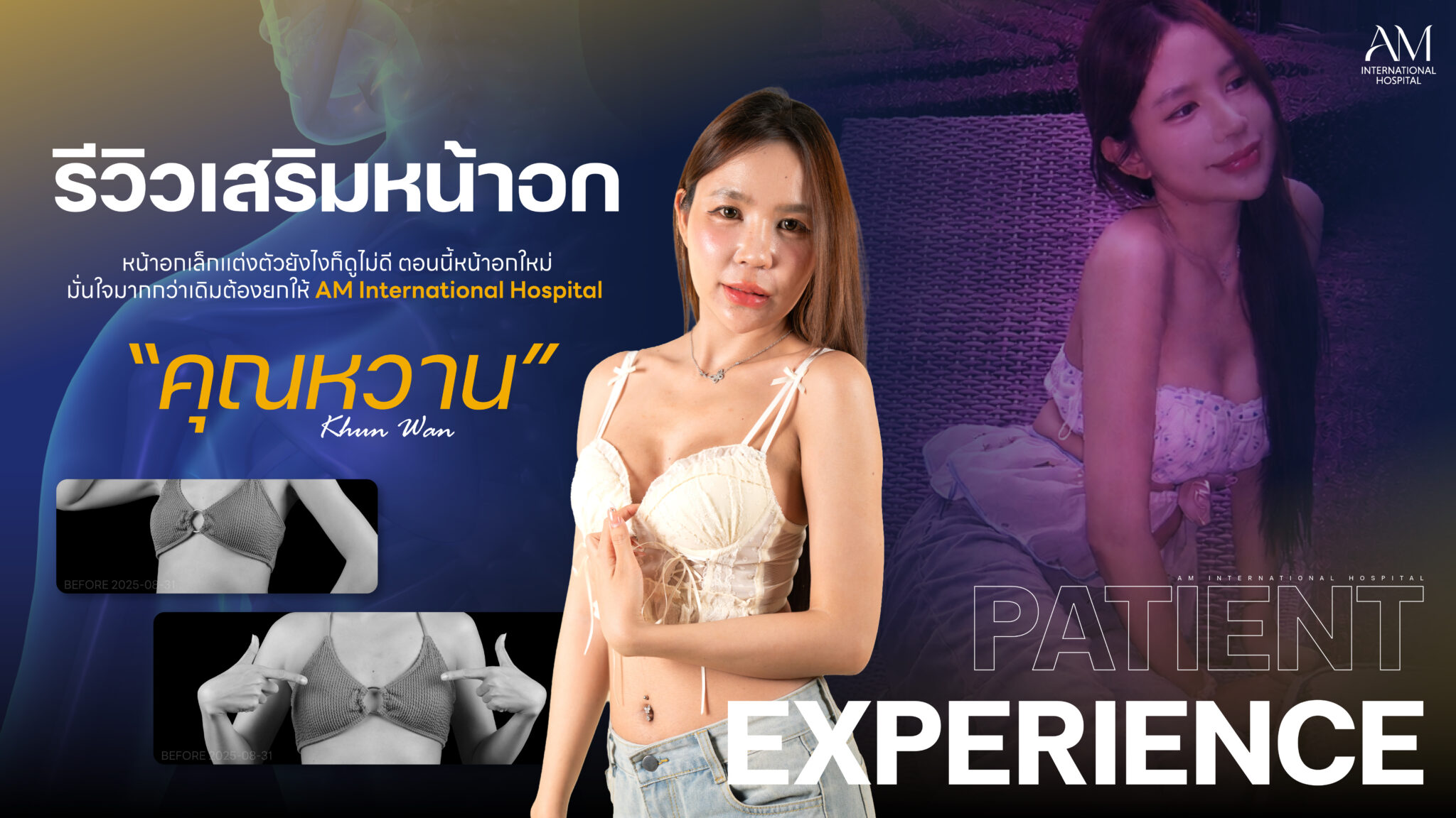 รีวิวเสริมหน้าอก