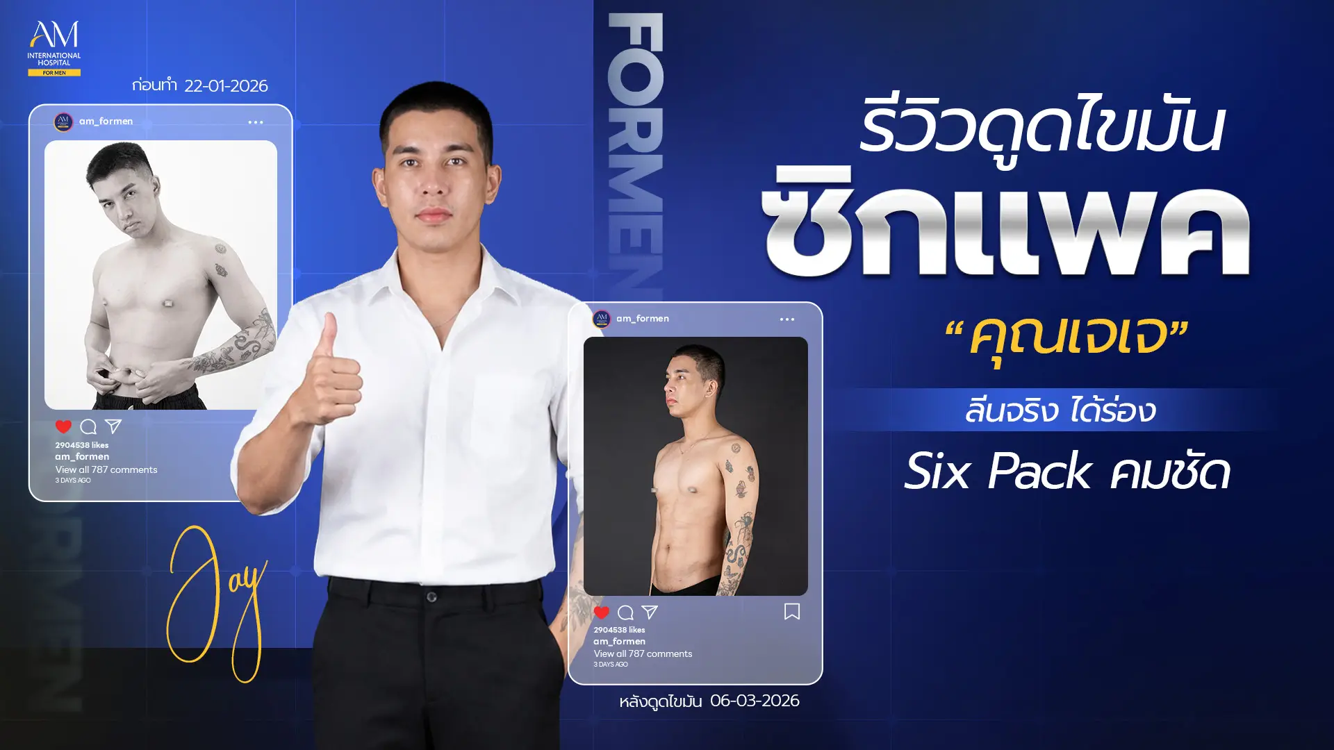 รีวิวดูดไขมันซิกแพค