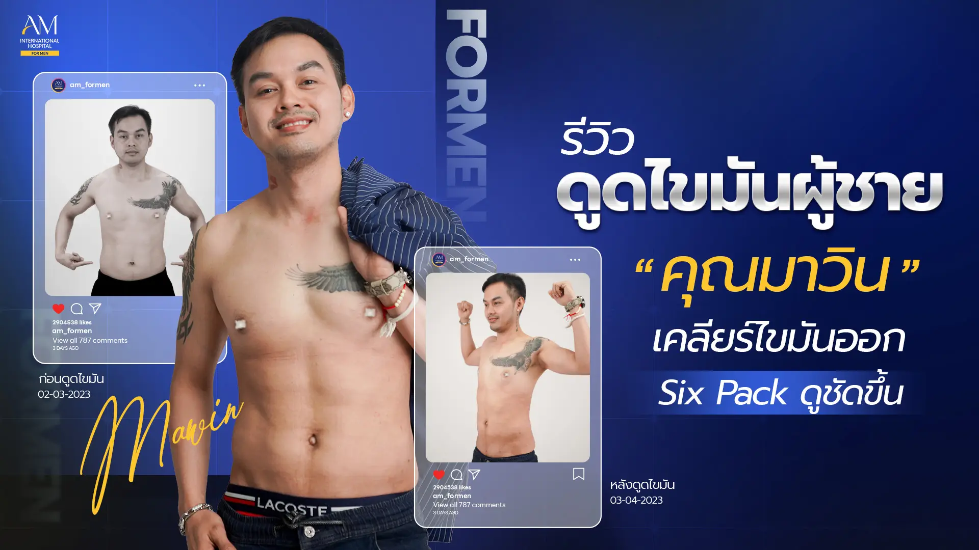 รีวิวดูดไขมัน