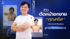รีวิวตัดหน้าอกชาย