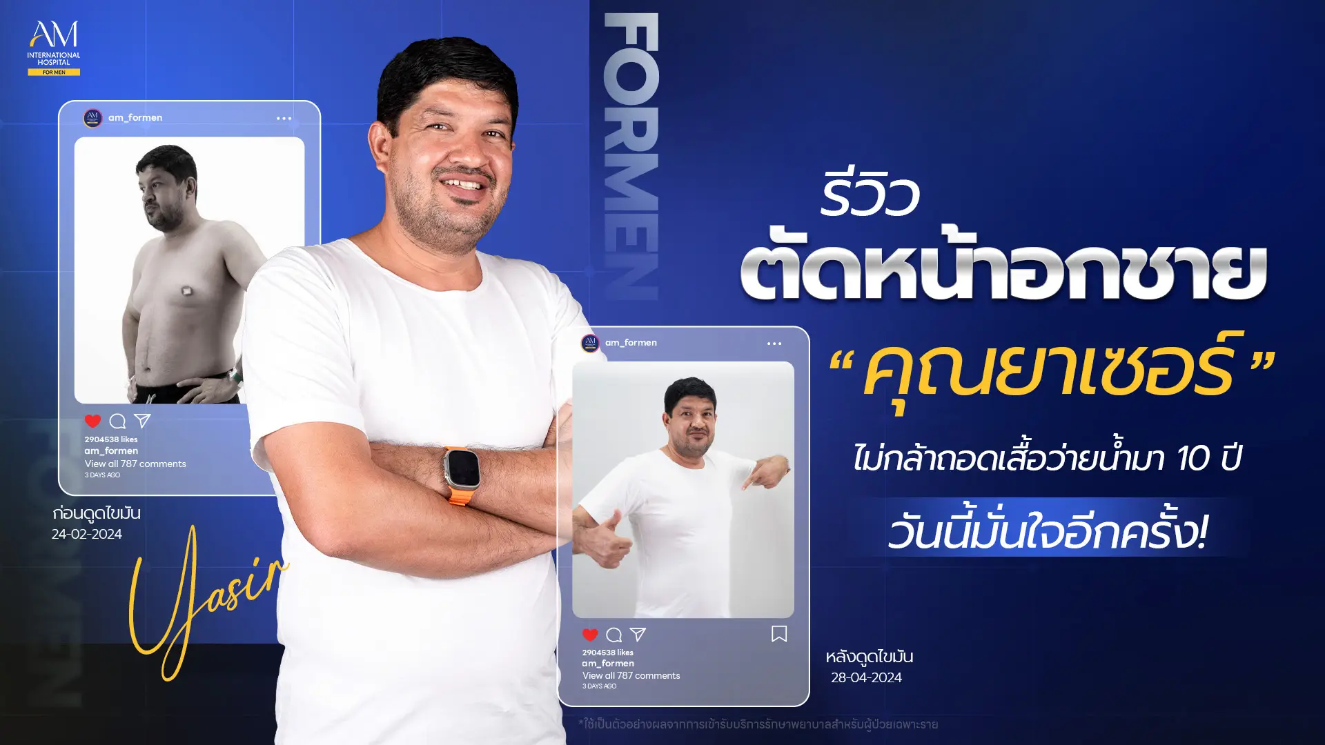 รีวิวตัดหน้าอกชาย