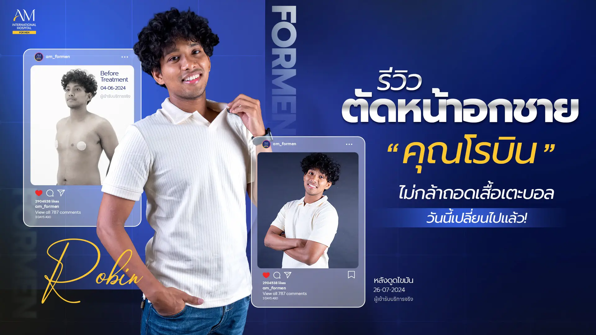 รีวิวตัดหน้าอกชาย