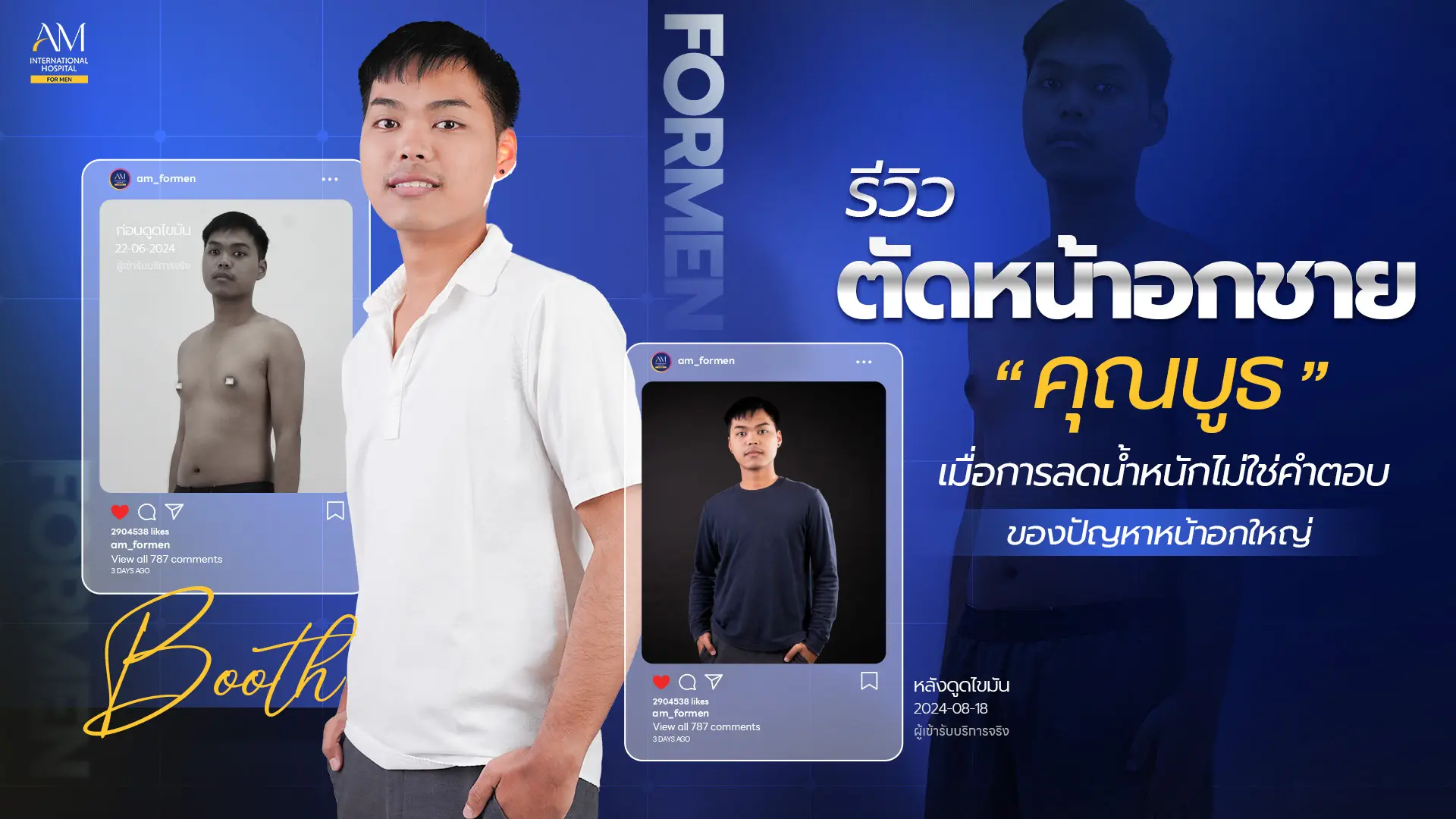 รีวิวตัดหน้าอกชาย
