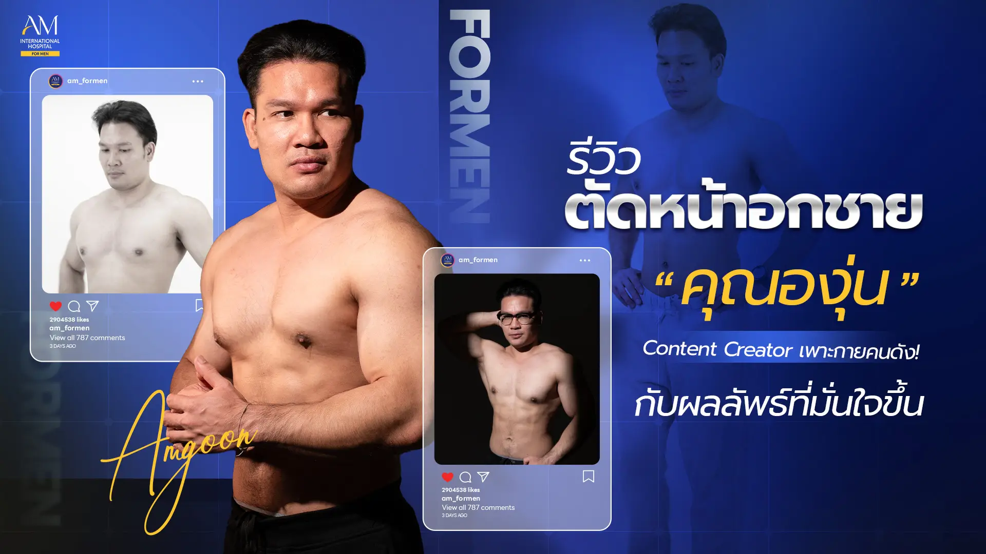 รีวิวตัดหน้าอกชาย