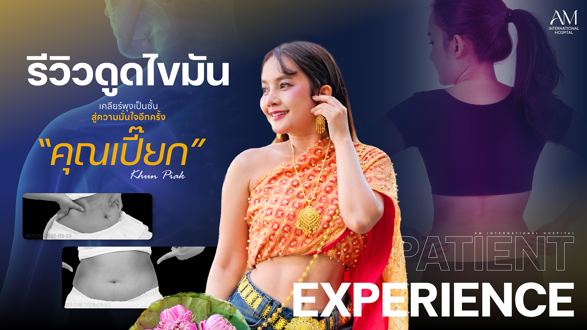 รีวิวดูดไขมัน