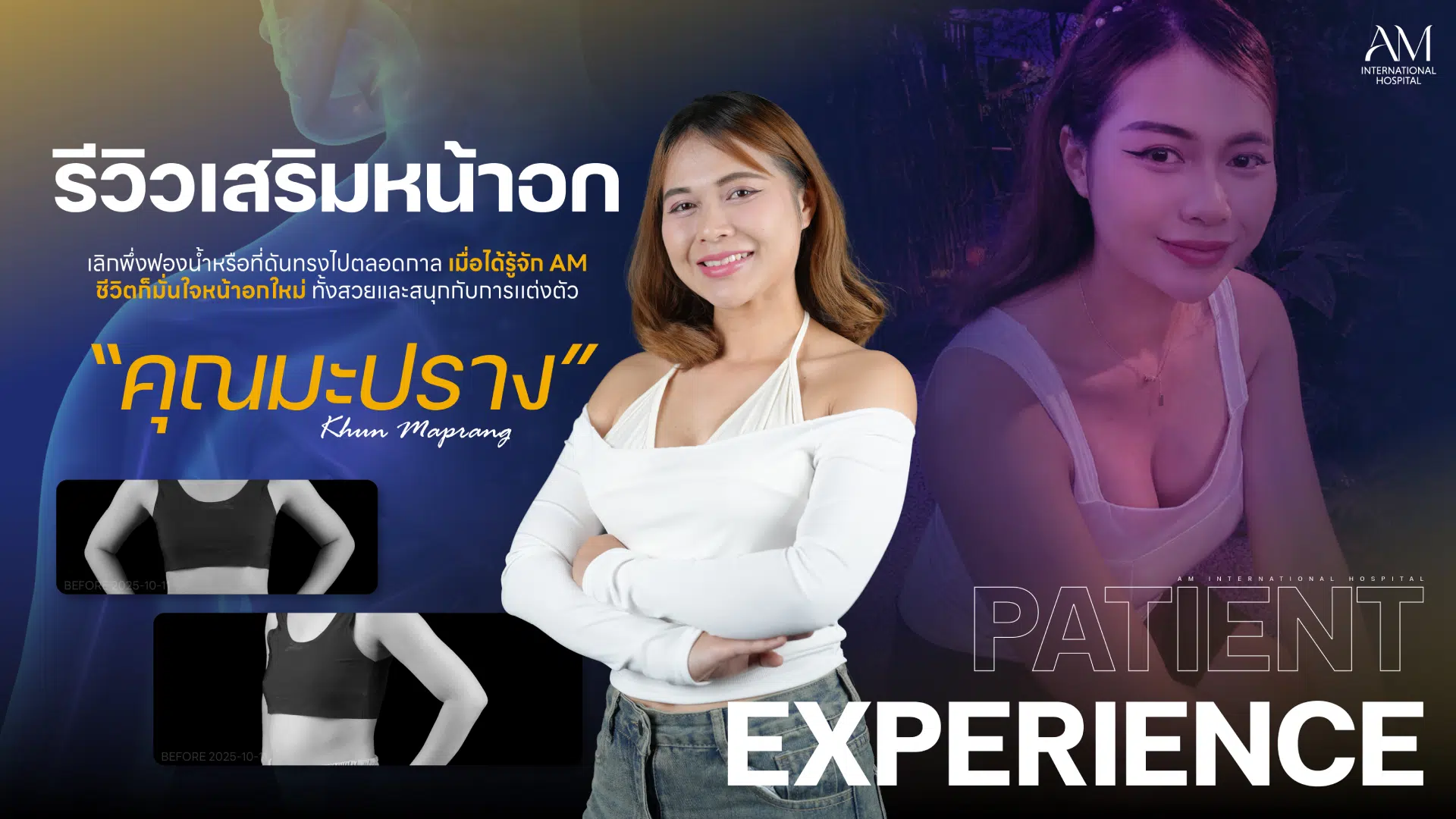 รีวิวเสริมหน้าอก