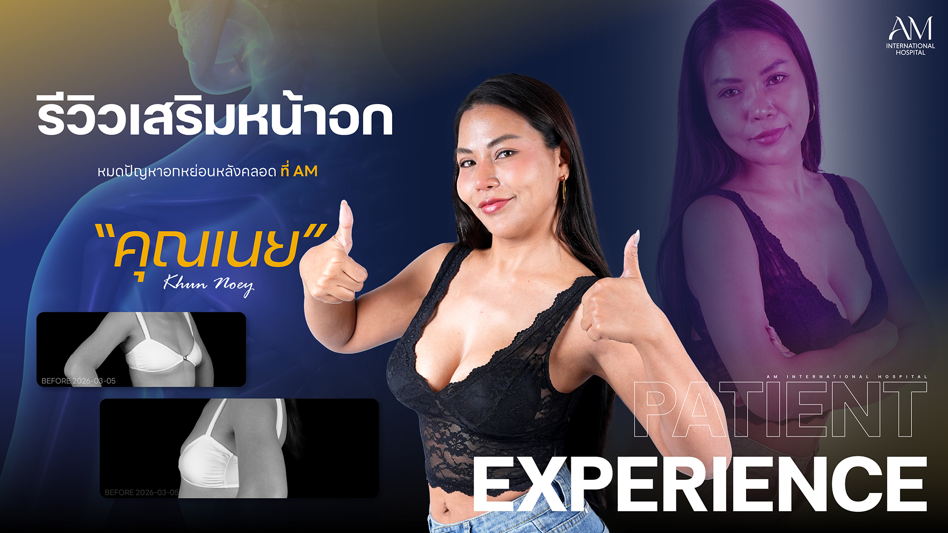 รีวิวเสริมหน้าอก