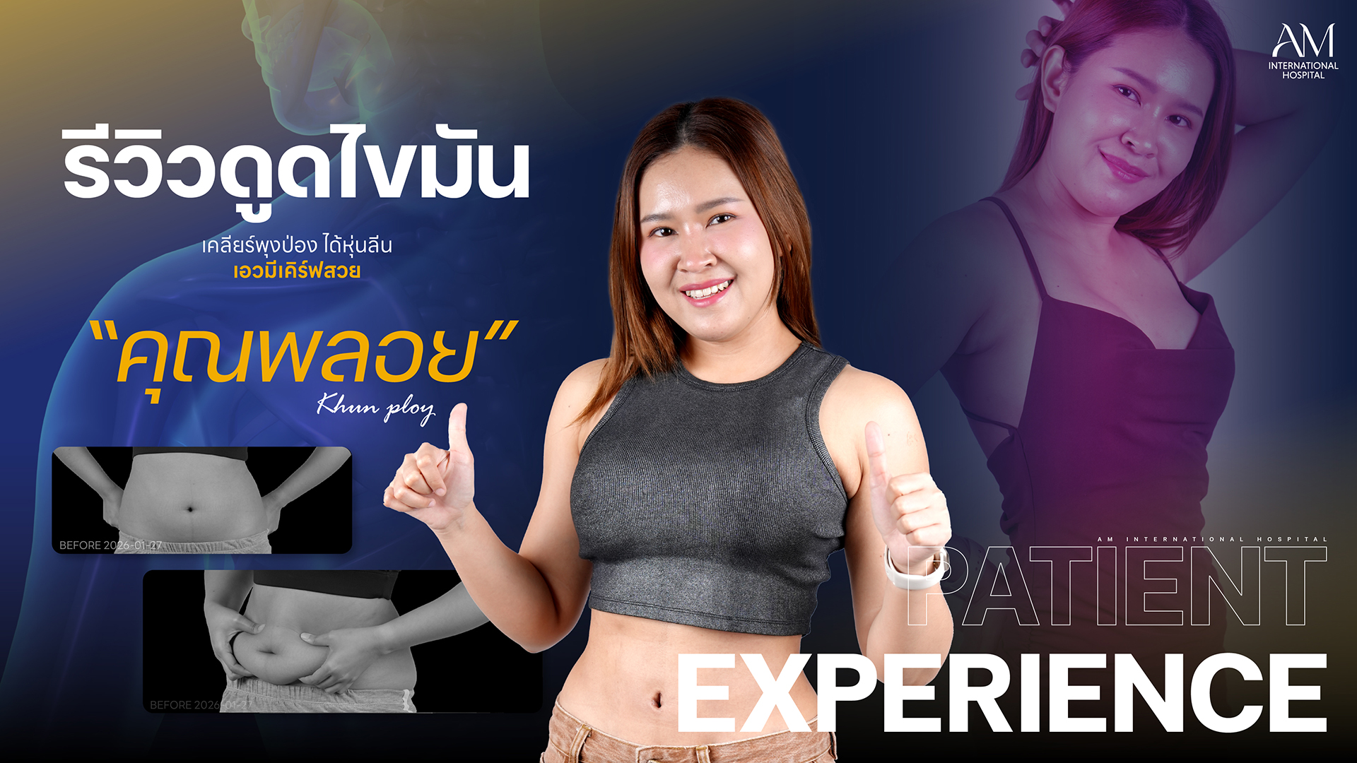 รีวิวดูดไขมัน