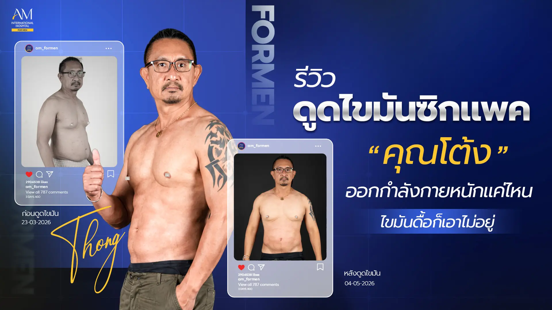 รีวิวดูดไขมันซิกแพค