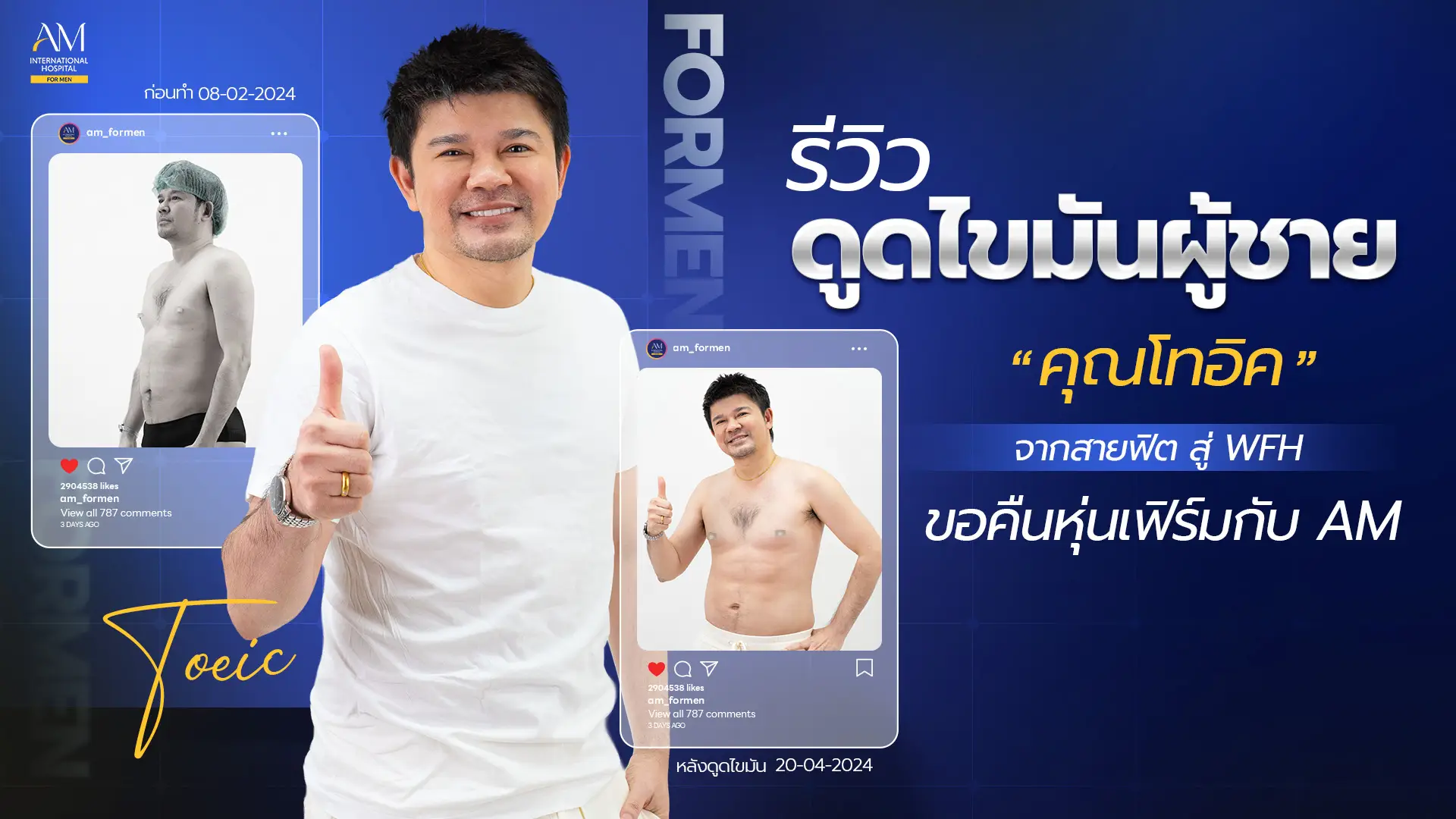 รีวิวดูดไขมันผู้ชาย