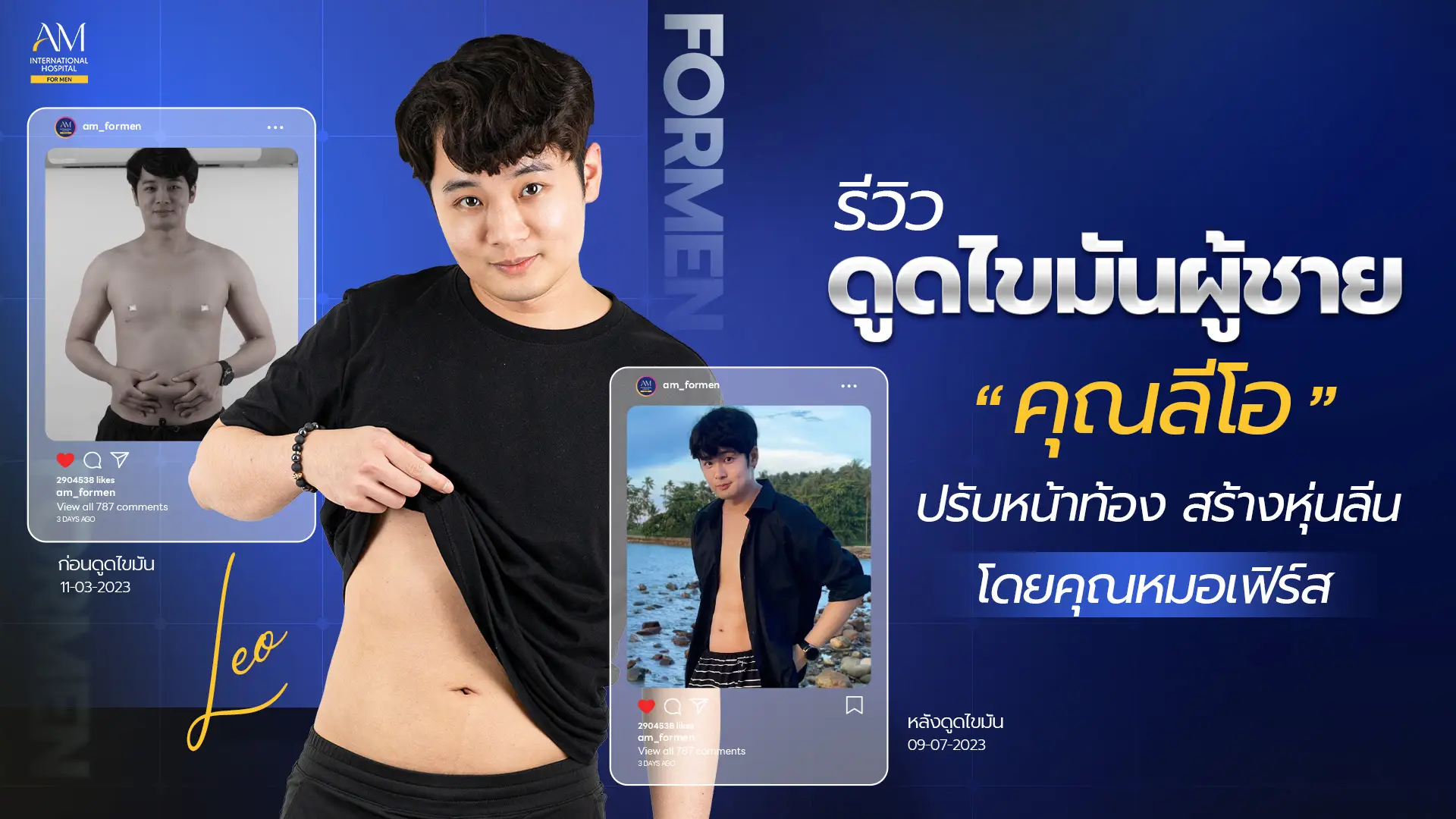 รีวิวดูดไขมัน