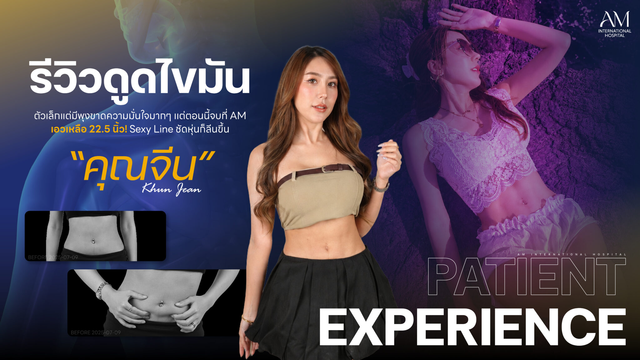 รีวิวดูดไขมัน “คุณจีน” เอวเหลือ 22.5 นิ้ว พร้อมร่อง Sexy Line เซ็กซี่เบา ๆ