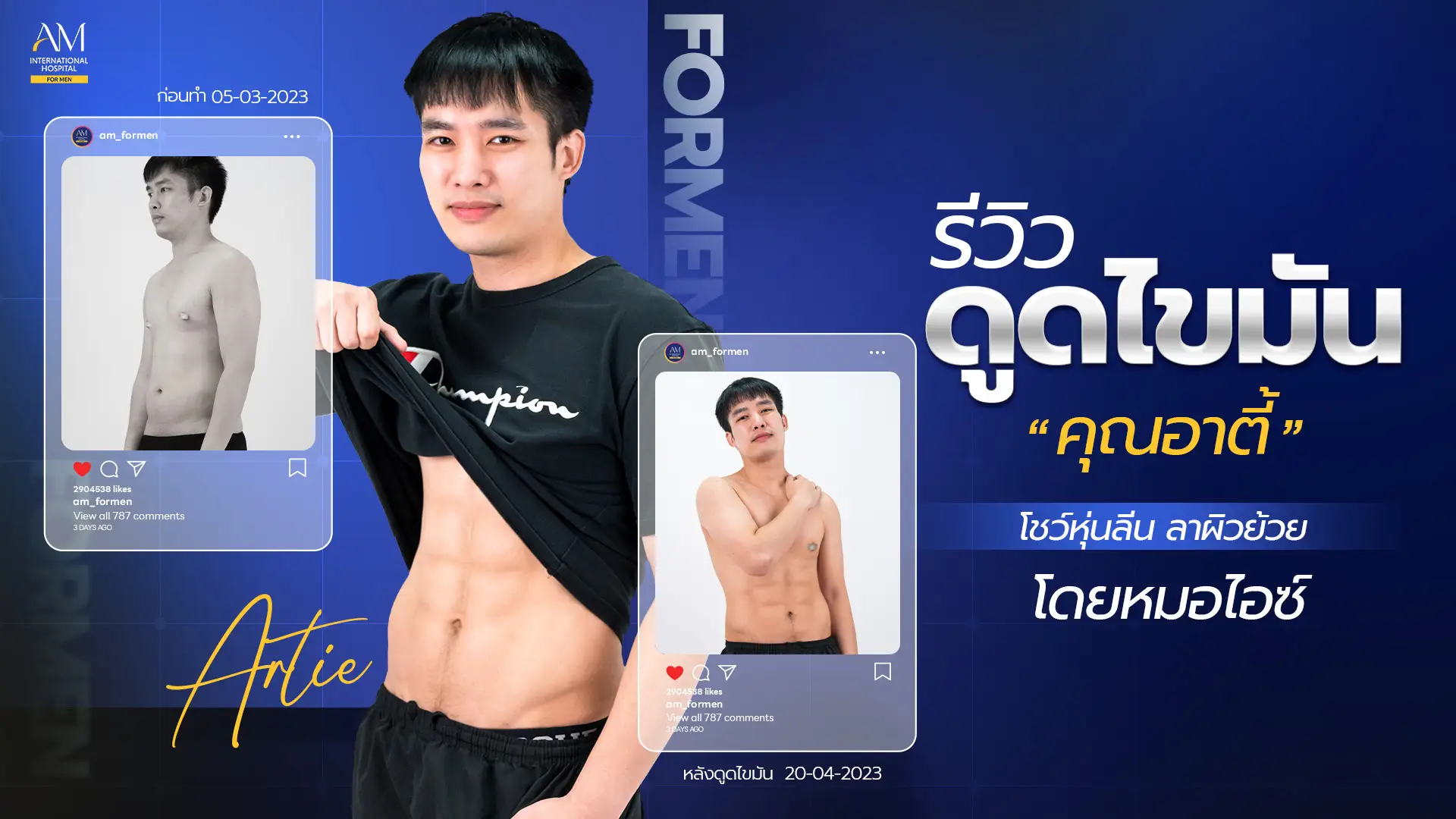 รีวิวดูดไขมัน