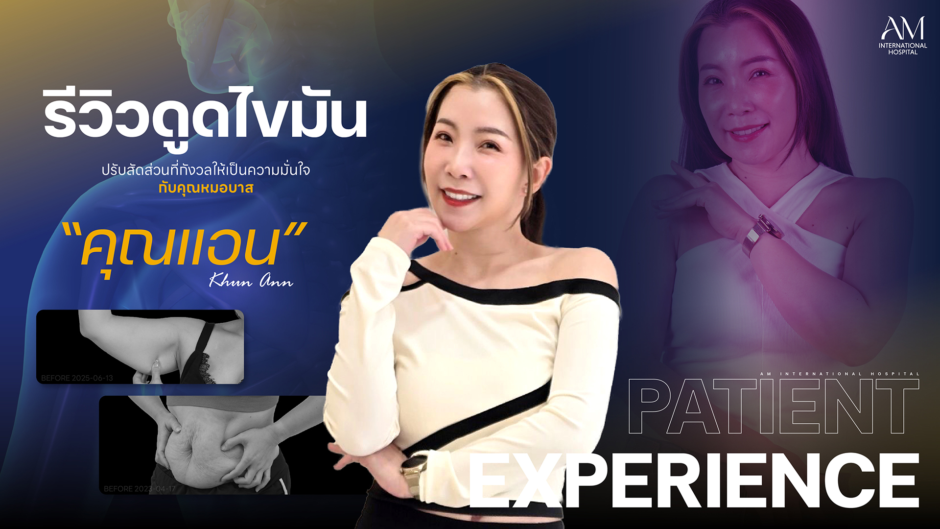 รีวิวดูดไขมัน