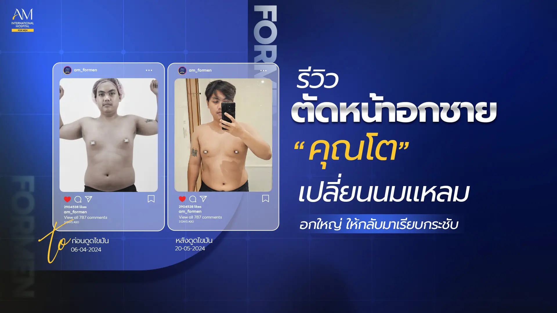 รีวิวตัดหน้าอกชาย