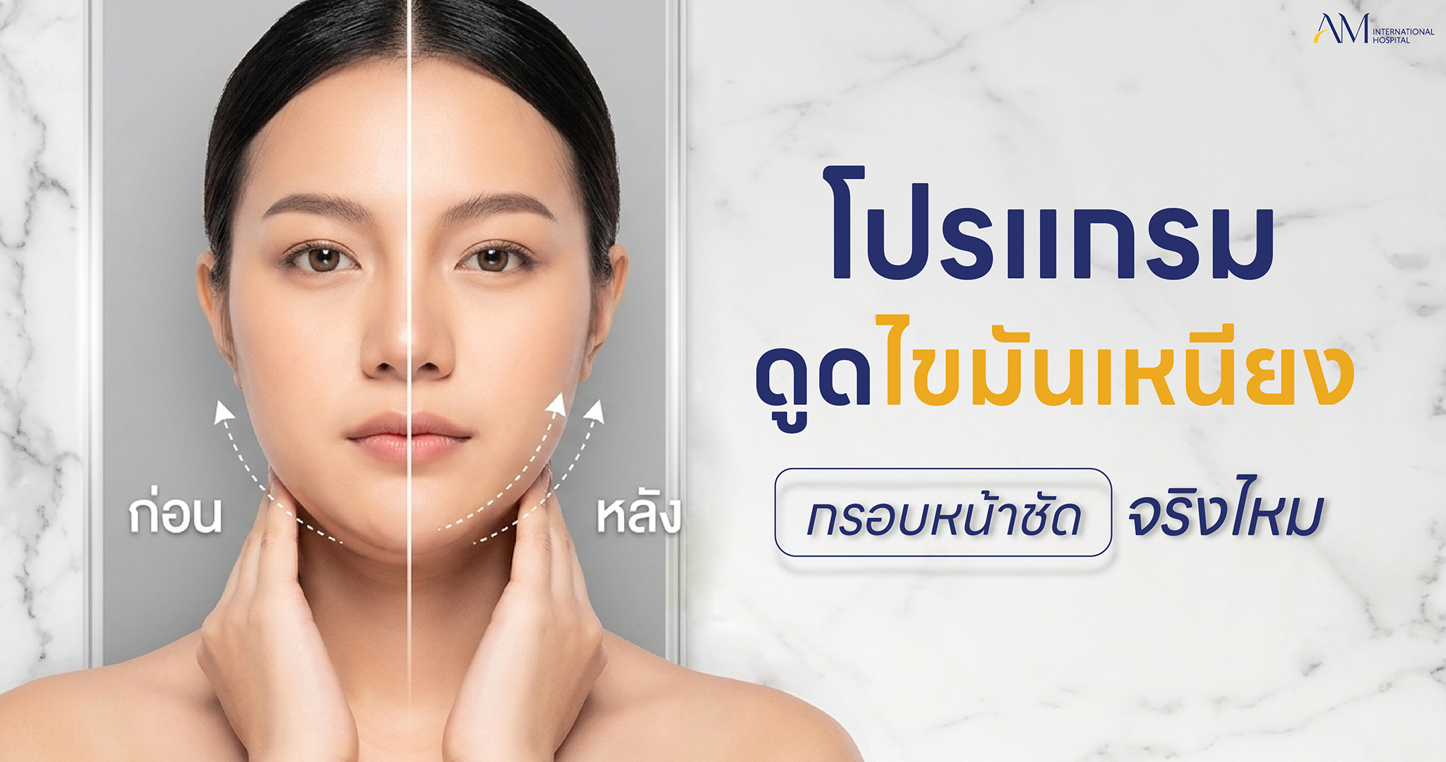 ดูดไขมันเหนียง