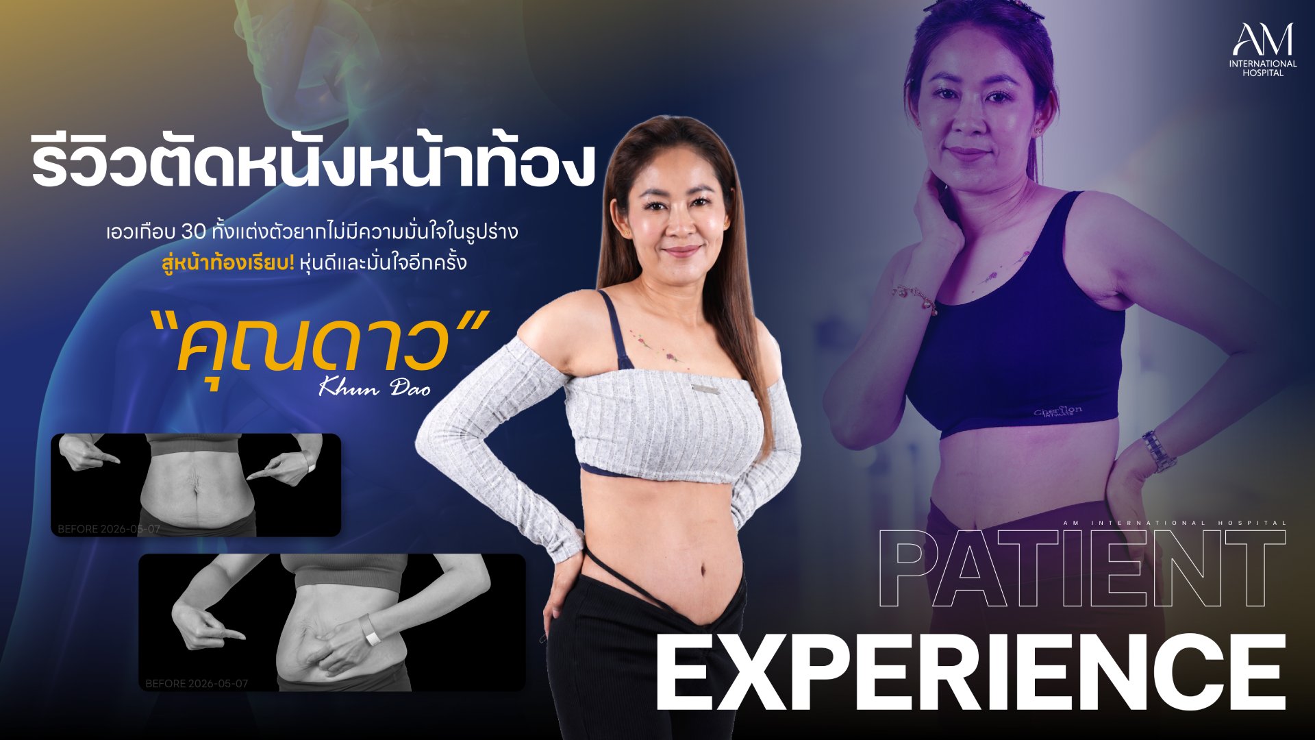 รีวิวตัดหนังหน้าท้อง