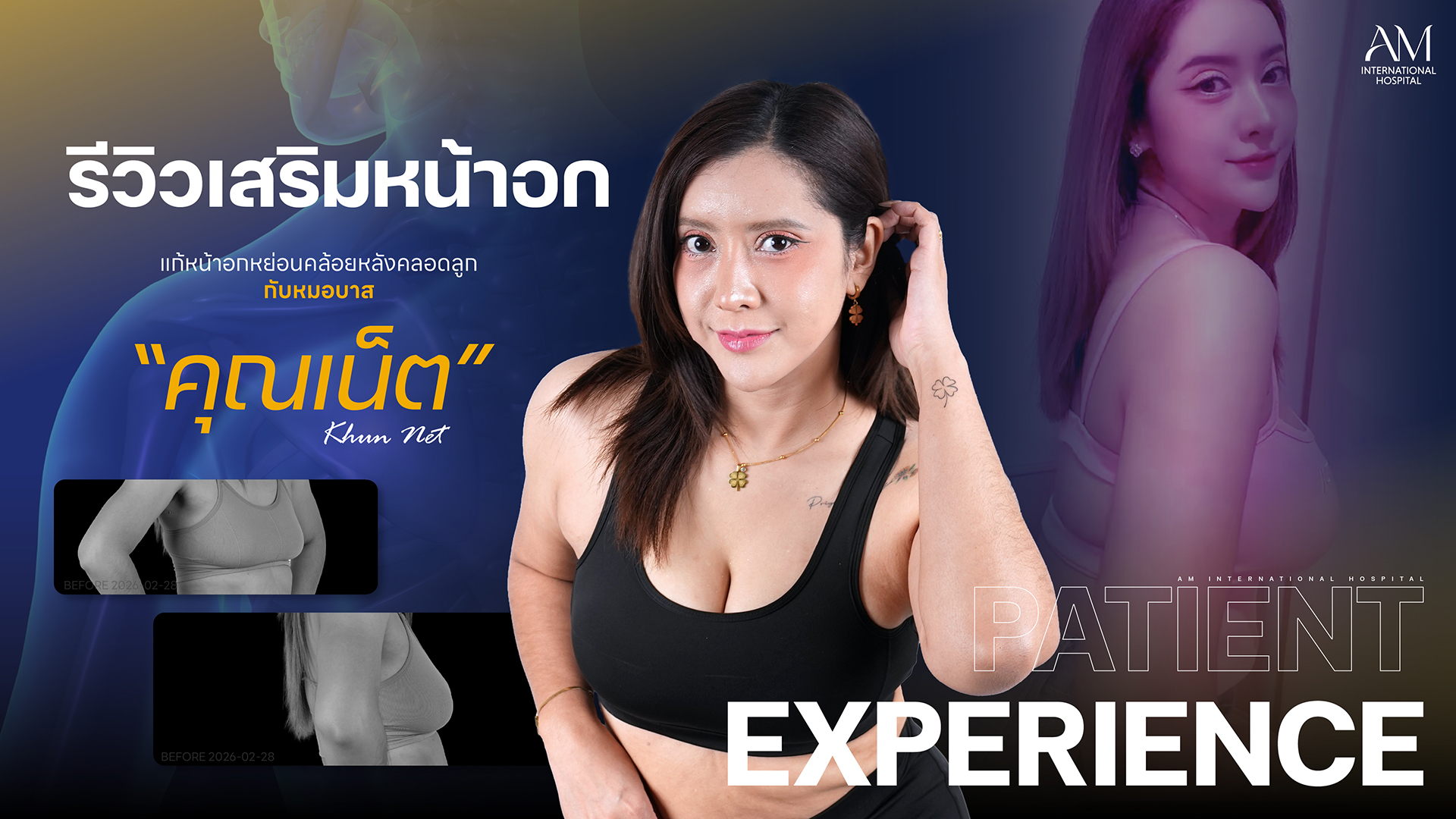 รีวิวเสริมหน้าอก