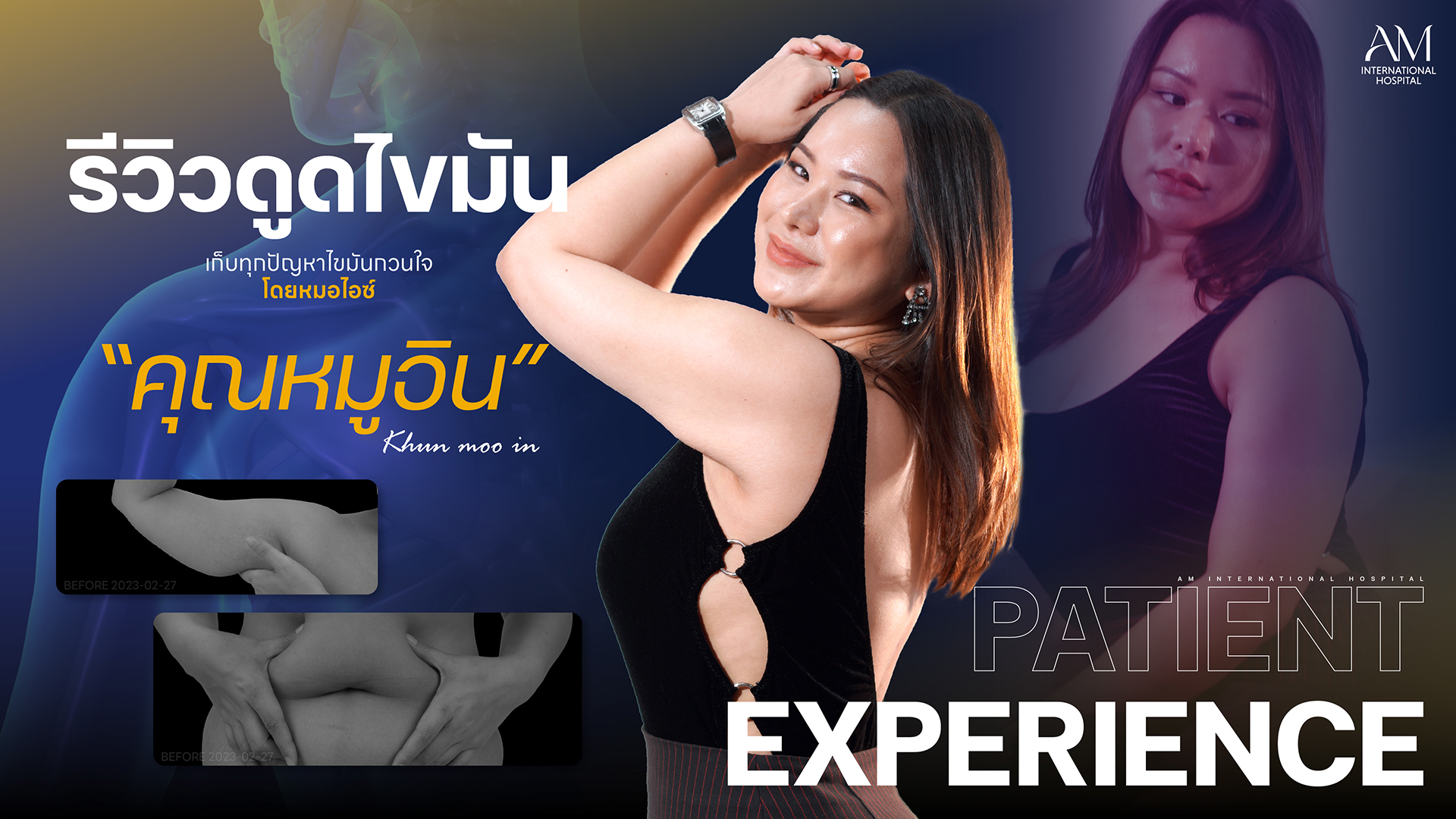 รีวิวดูดไขมัน