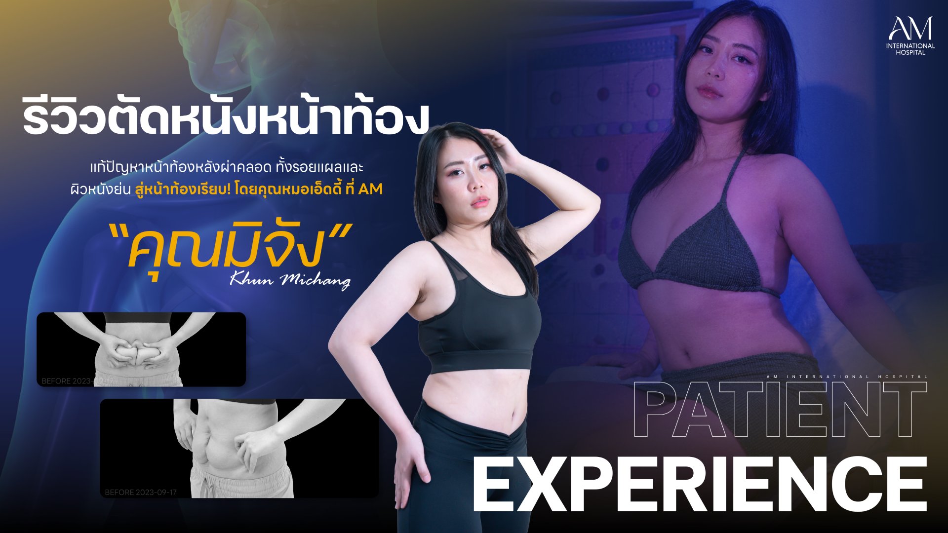รีวิวตัดหนังหน้าท้อง
