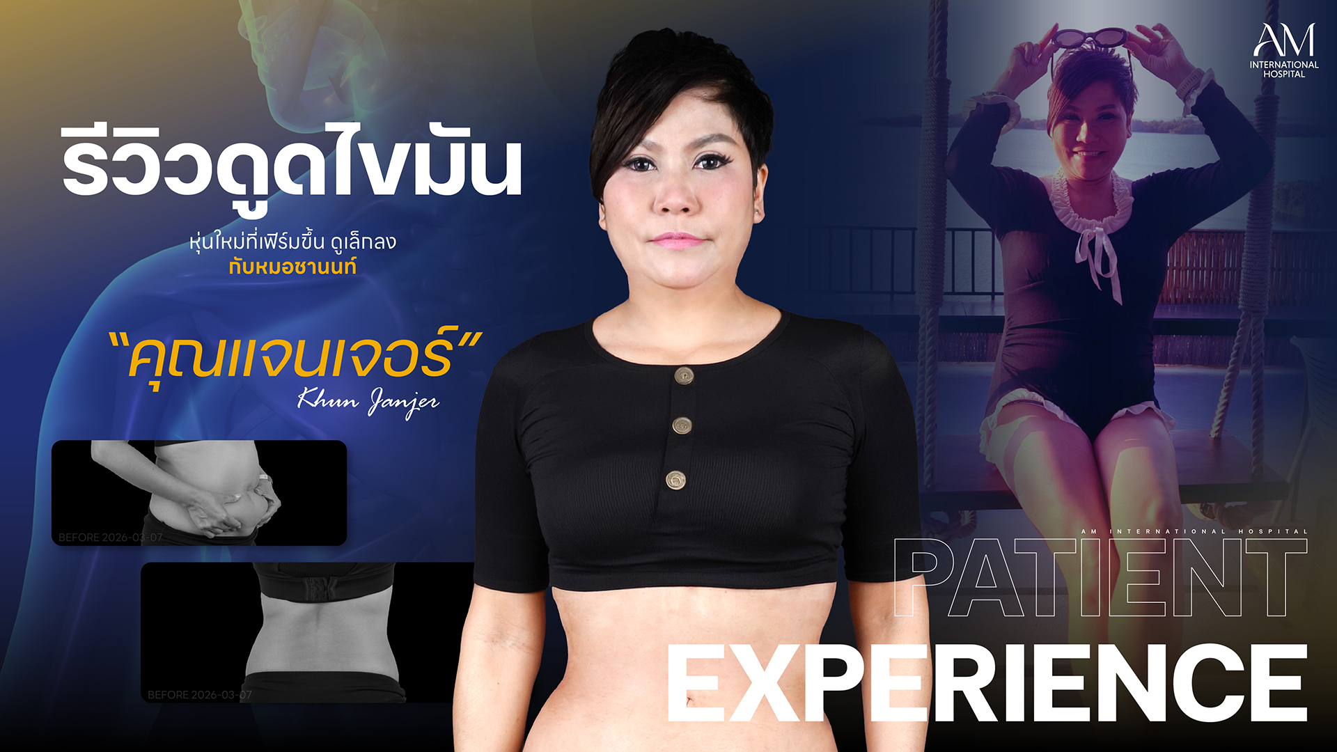 รีวิวดูดไขมัน