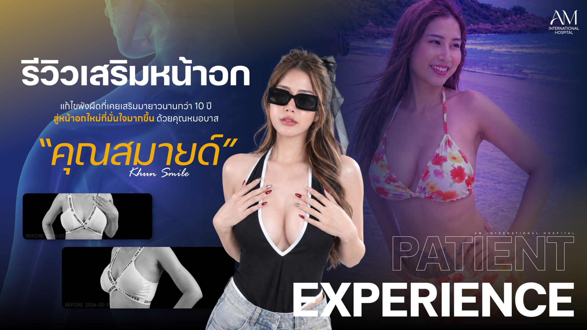 รีวิวเสริมหน้าอก