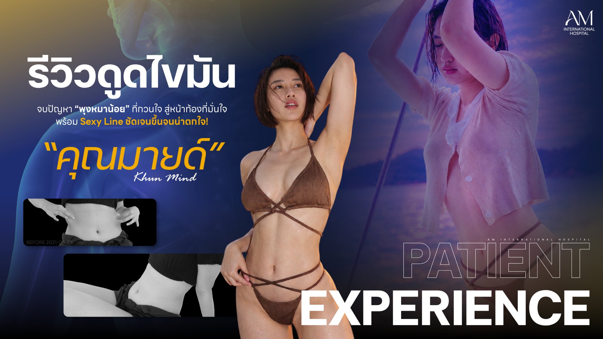 รีวิวดูดไขมัน