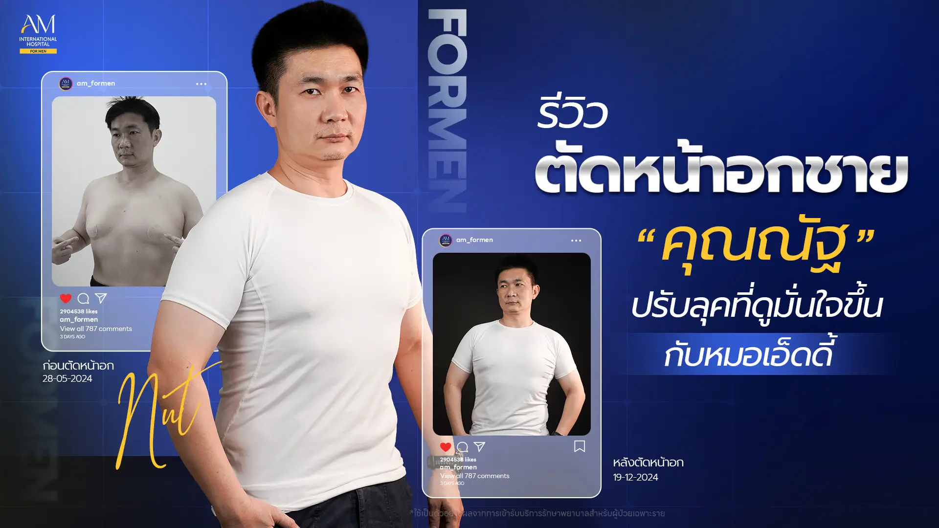 รีวิวตัดหน้าอกชาย