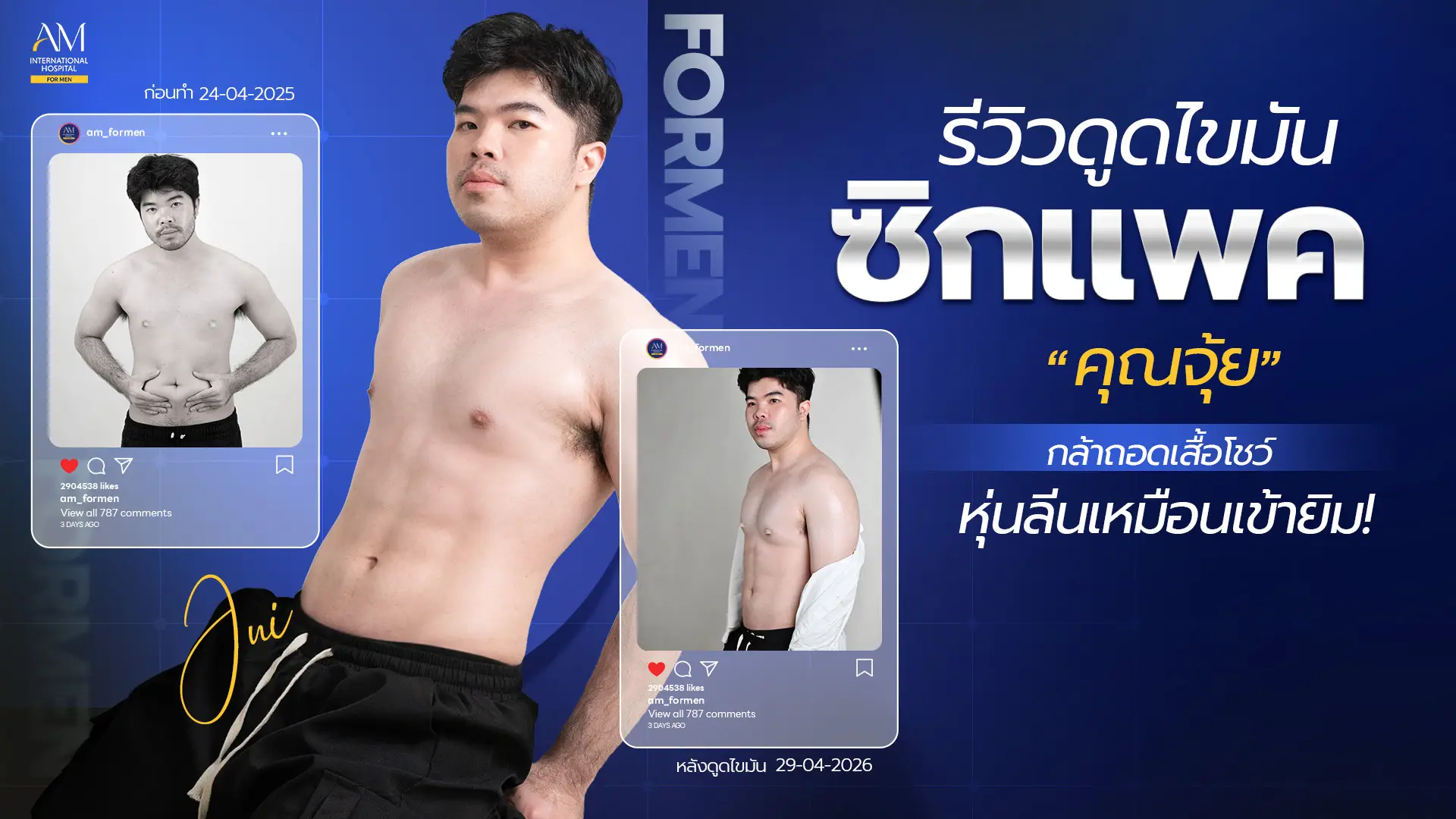 รีวิวดูดไขมันซิกแพค
