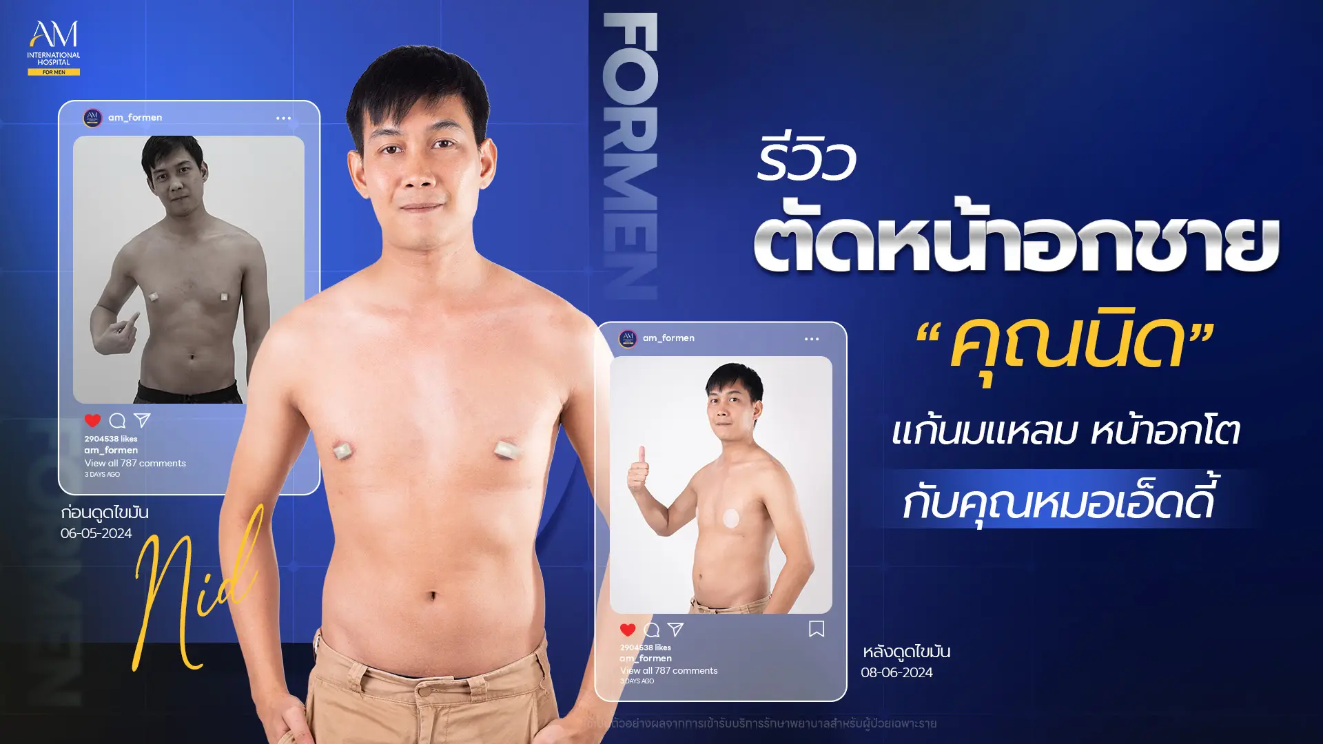 รีวิวตัดหน้าอกชาย