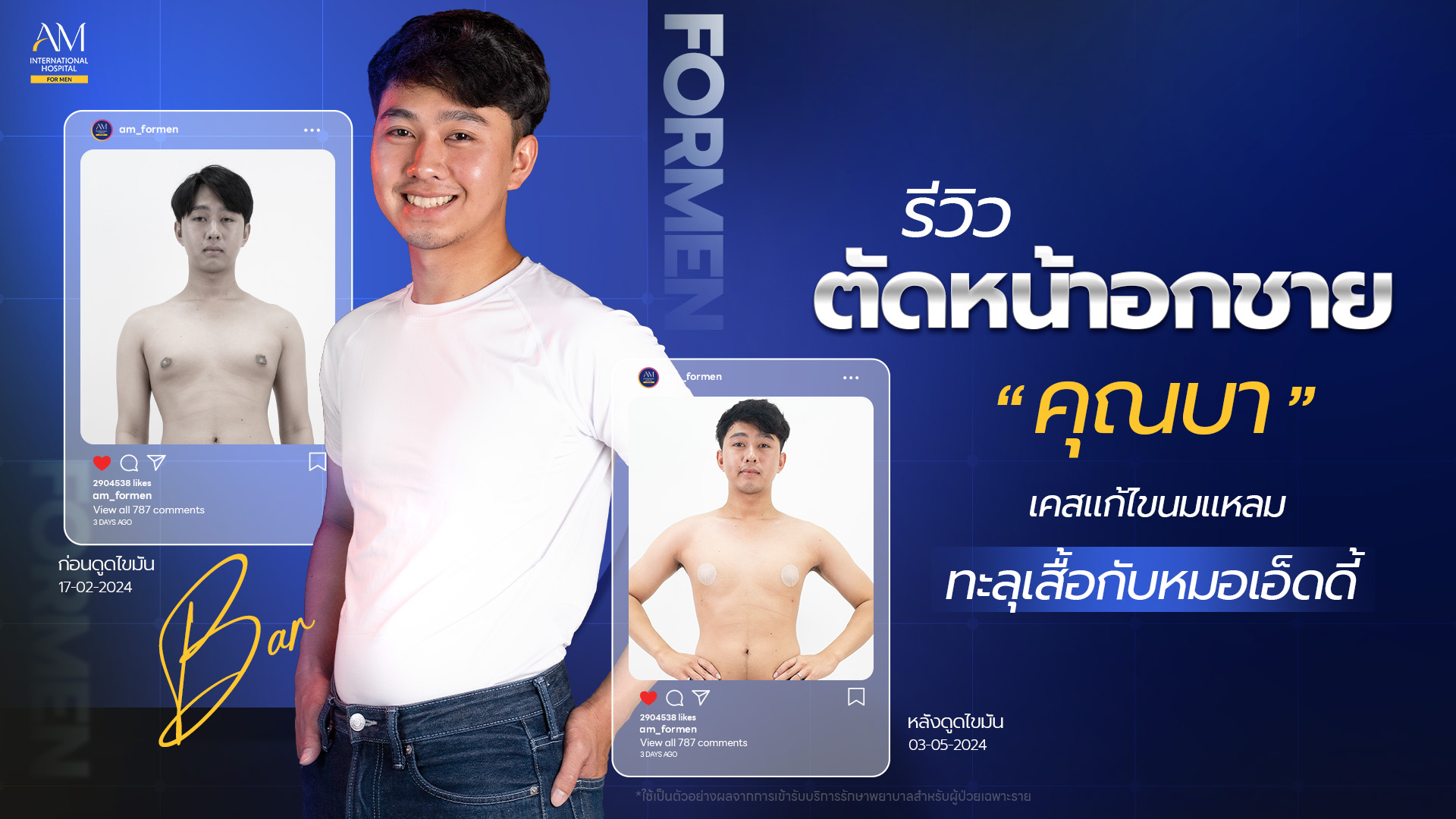 รีวิวตัดหน้าอกชาย