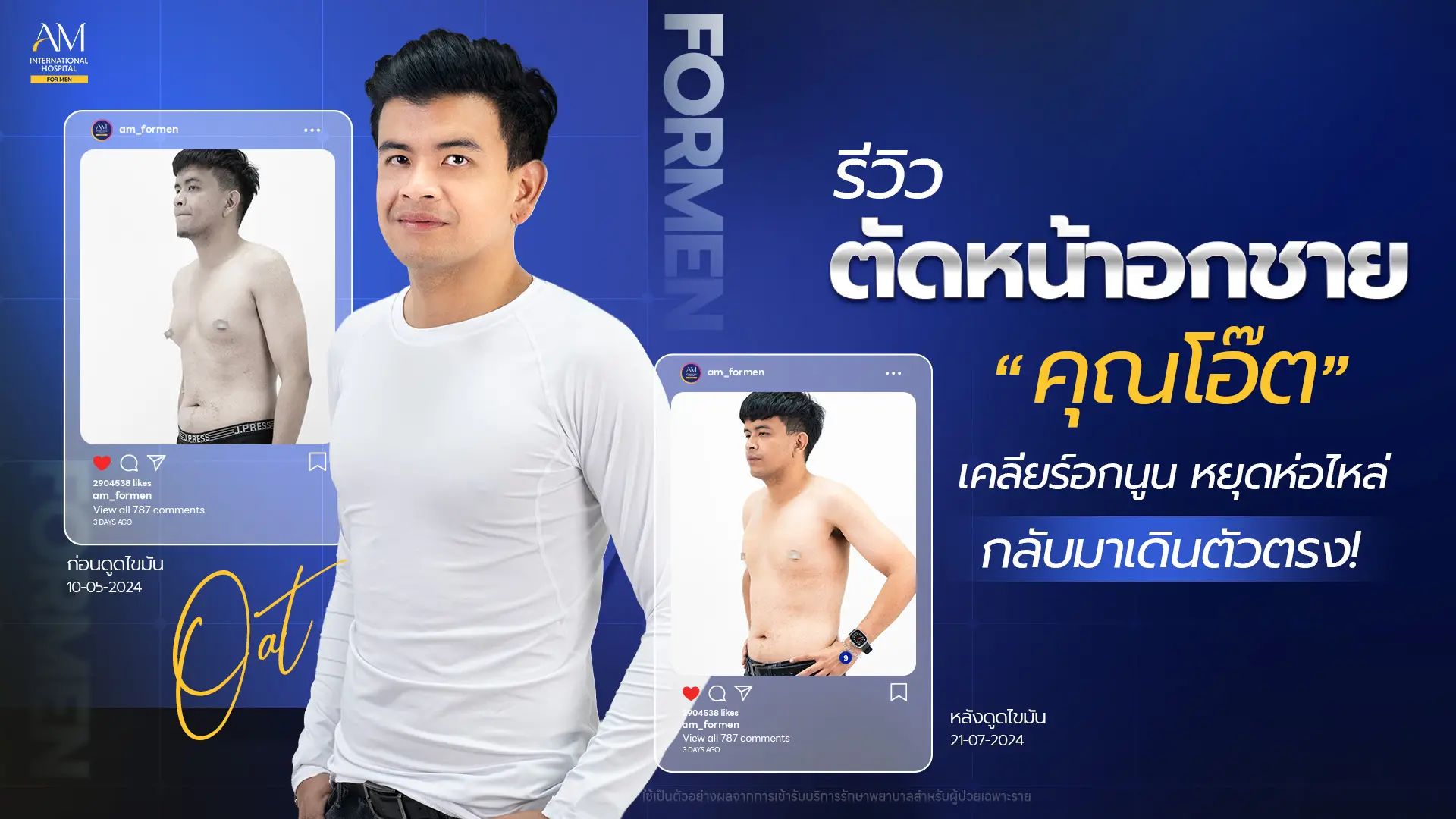 รีวิวตัดหน้าอกชาย